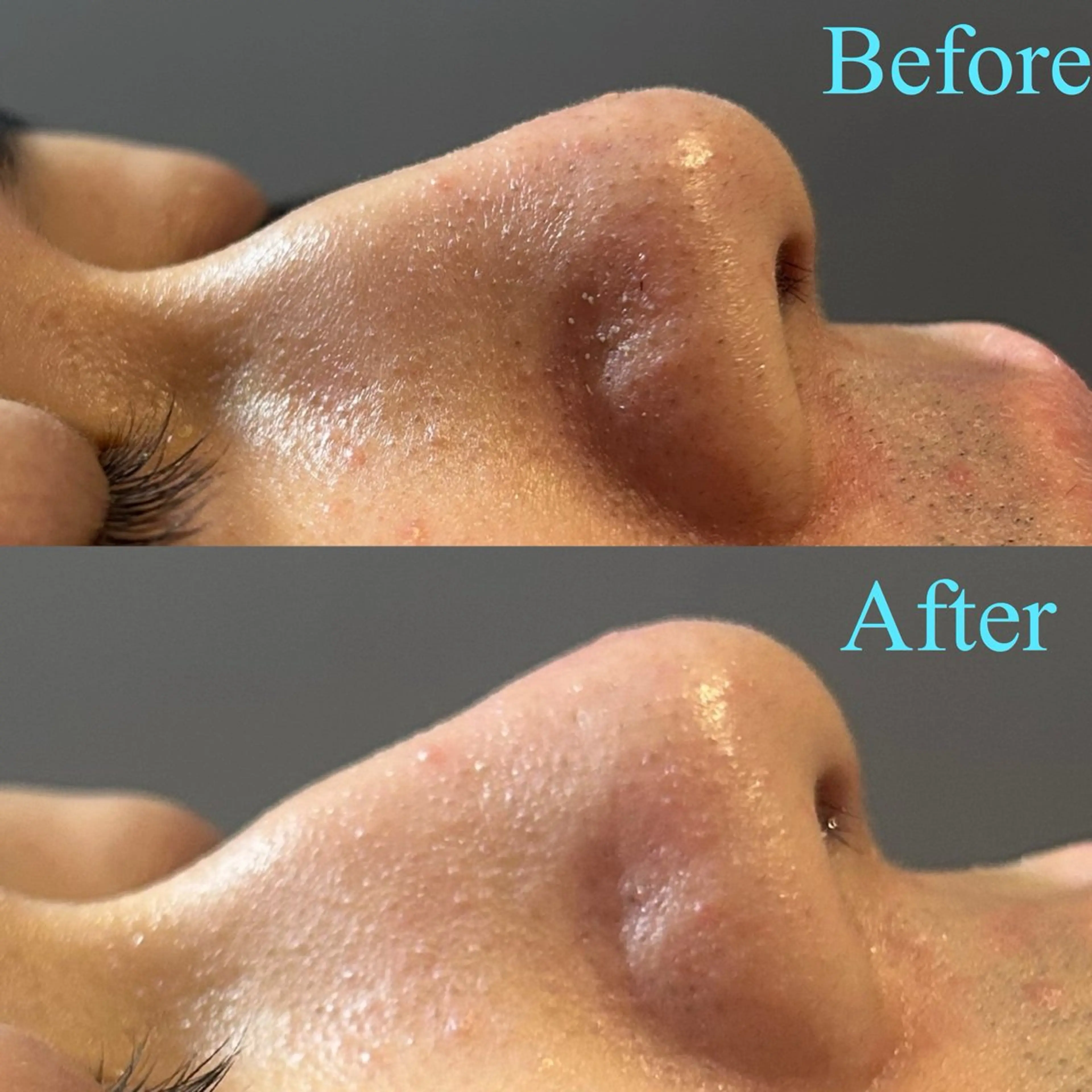 ❄️12月限定❄️毛穴洗浄コースの写真