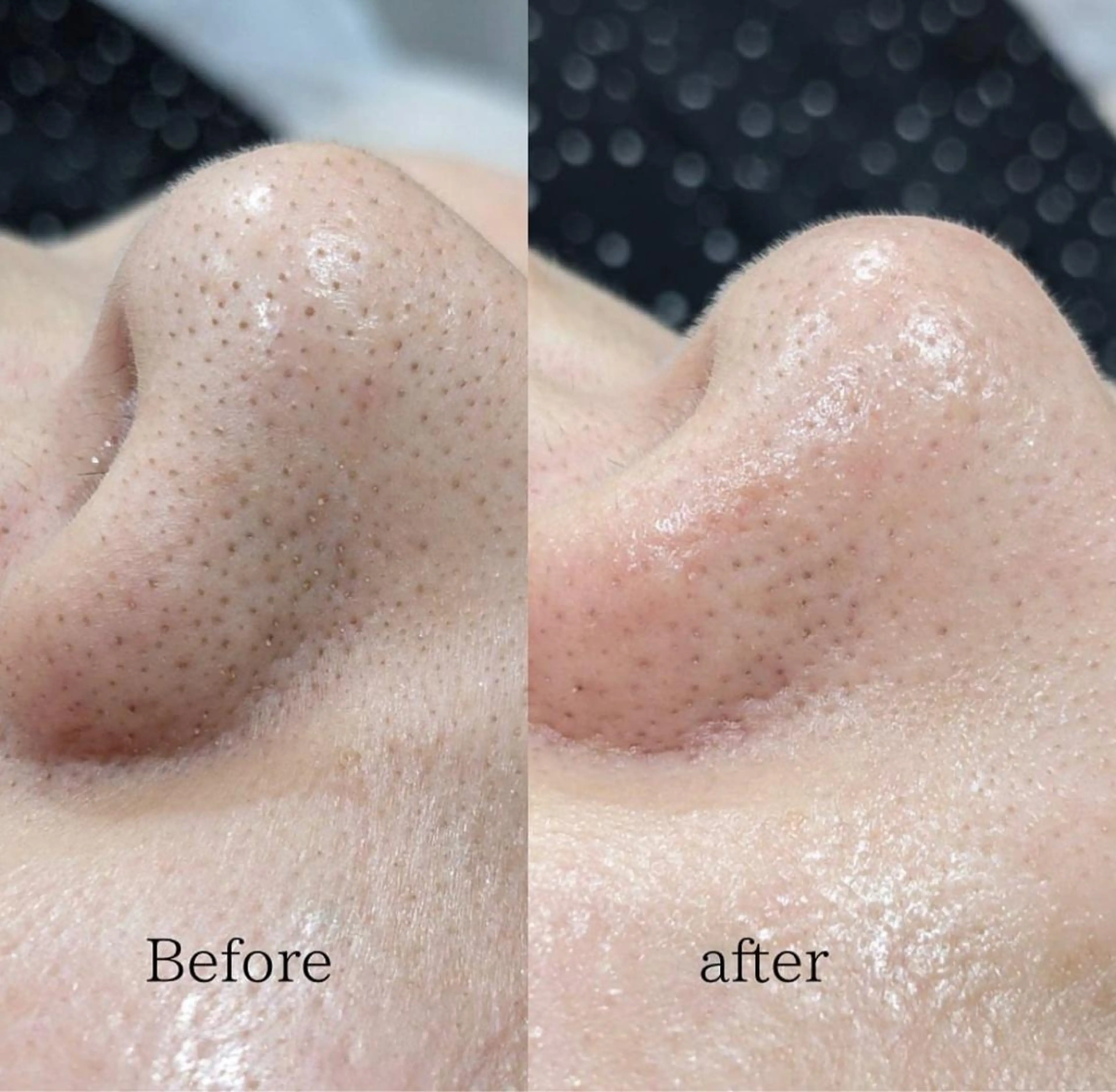 【黒ずみ/くすみ/ニキビ】話題の毛穴洗浄✨の写真