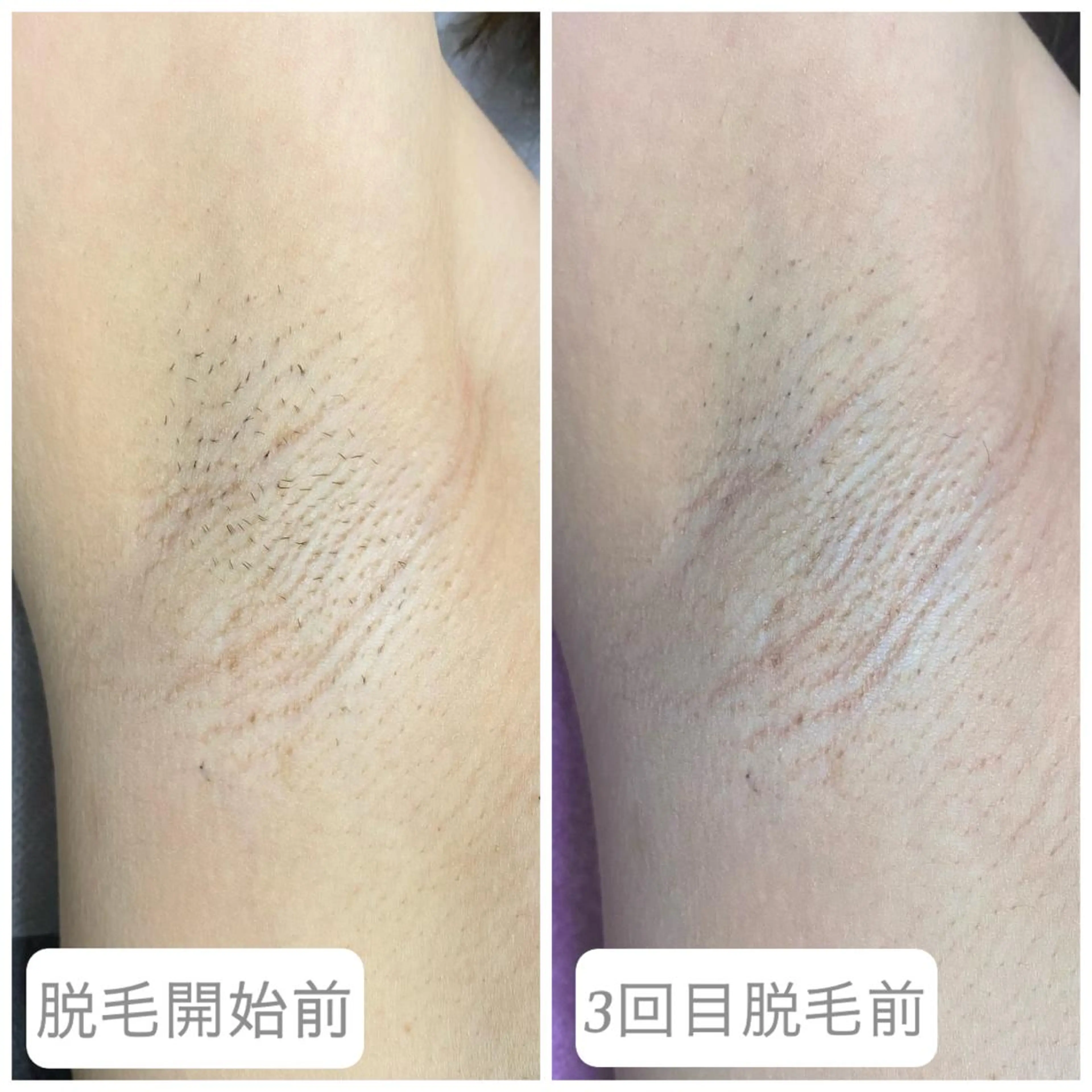 脇脱毛1回の写真