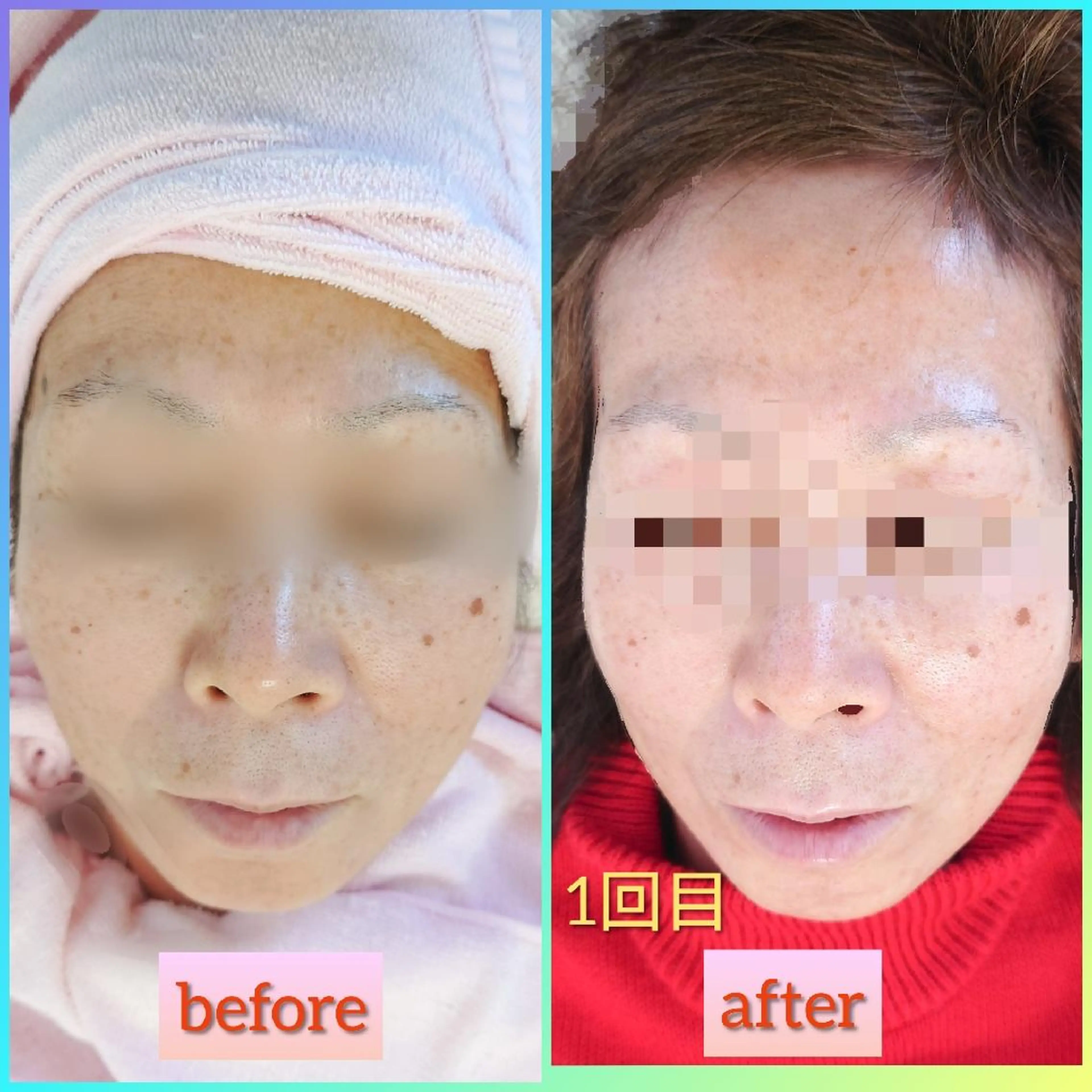 小顔DX  フォーカスネオ×小顔ケア✨の写真