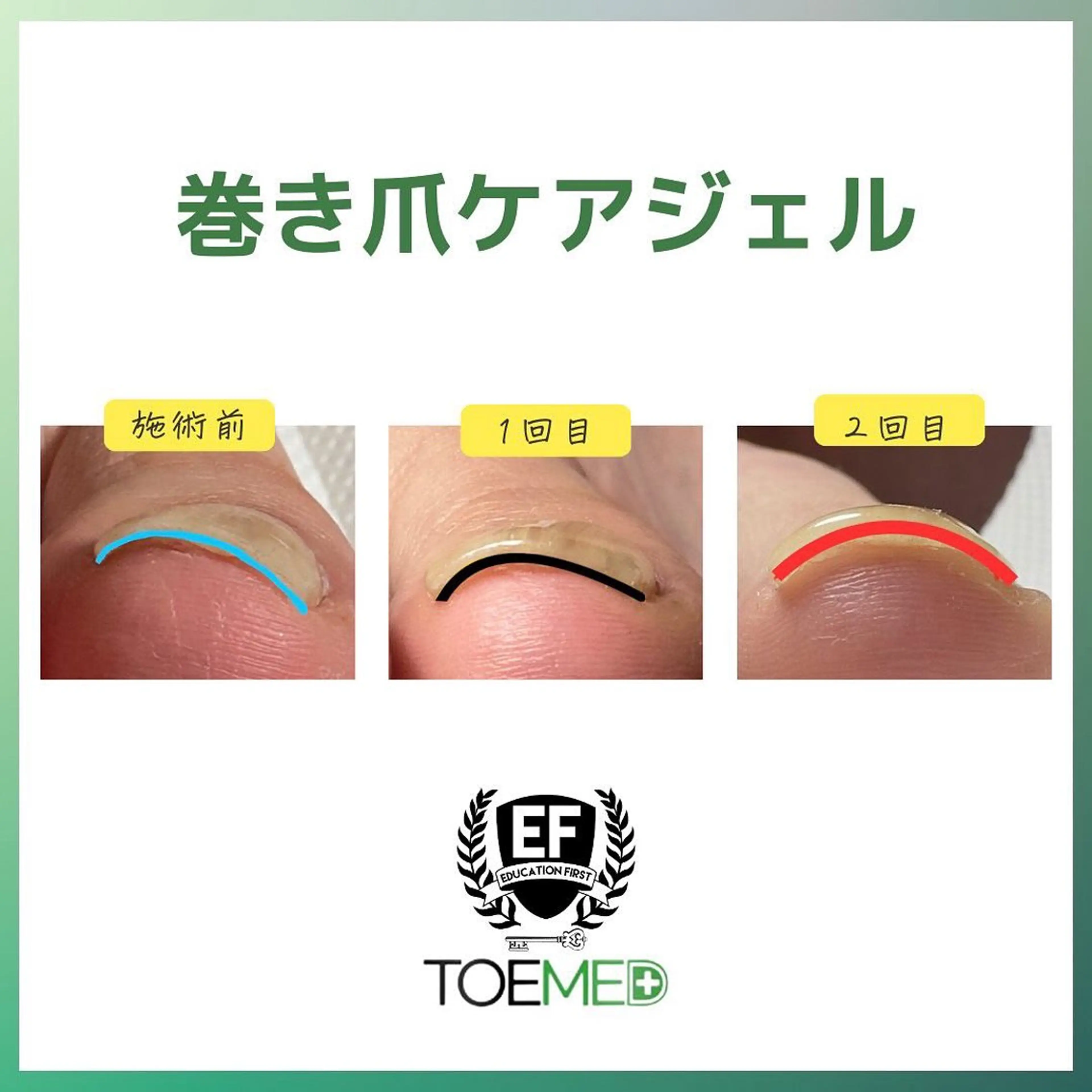 【巻き爪】韓国皮膚科医監修🇰🇷全く痛みを伴わない巻き爪専用ジェルで巻き爪を緩和#ワンカラーでお仕上げ🌼の写真