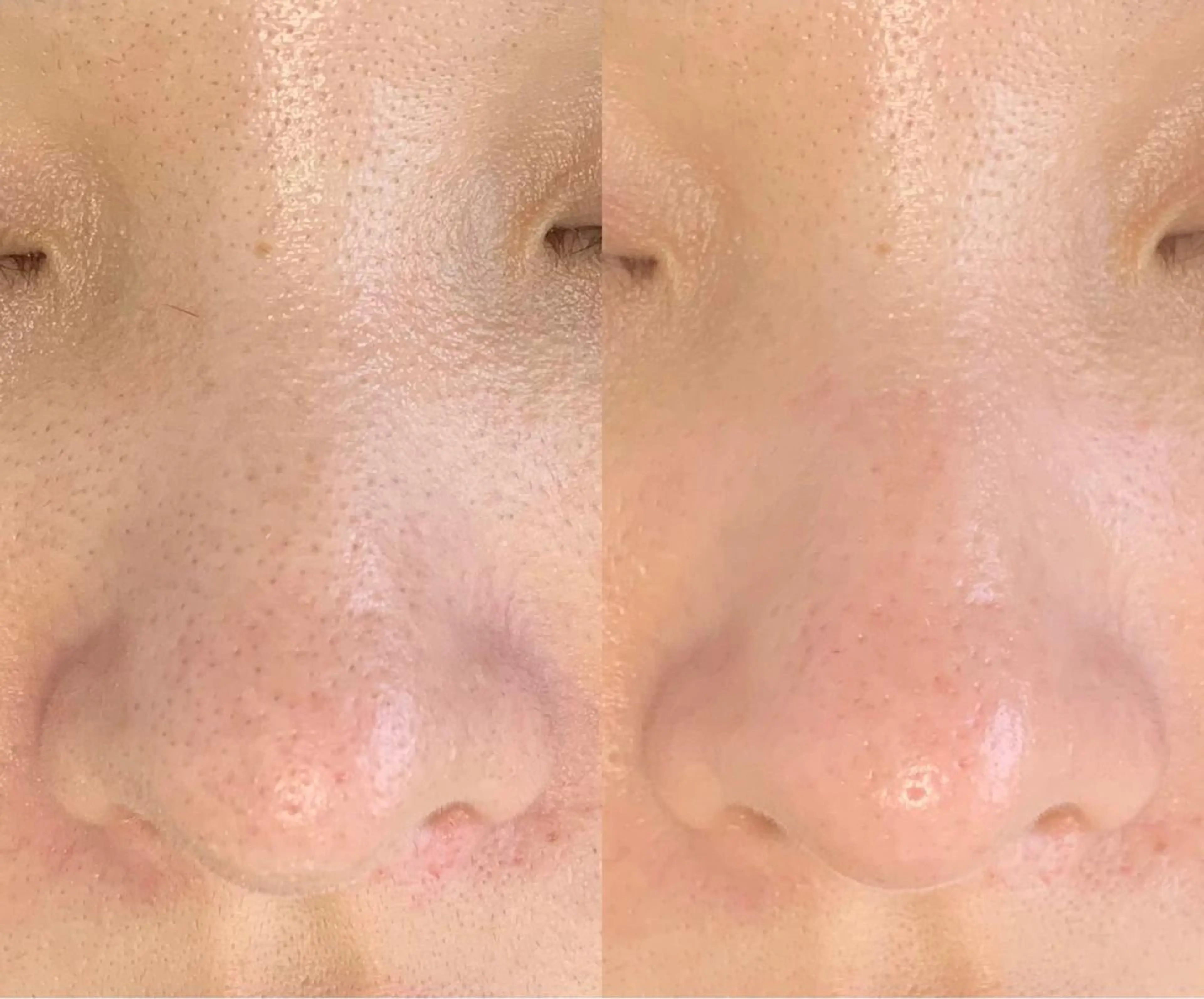 \毛穴ハイドロピーリング●鼻●/ご来店時メイクはせずにお越しください♡の写真