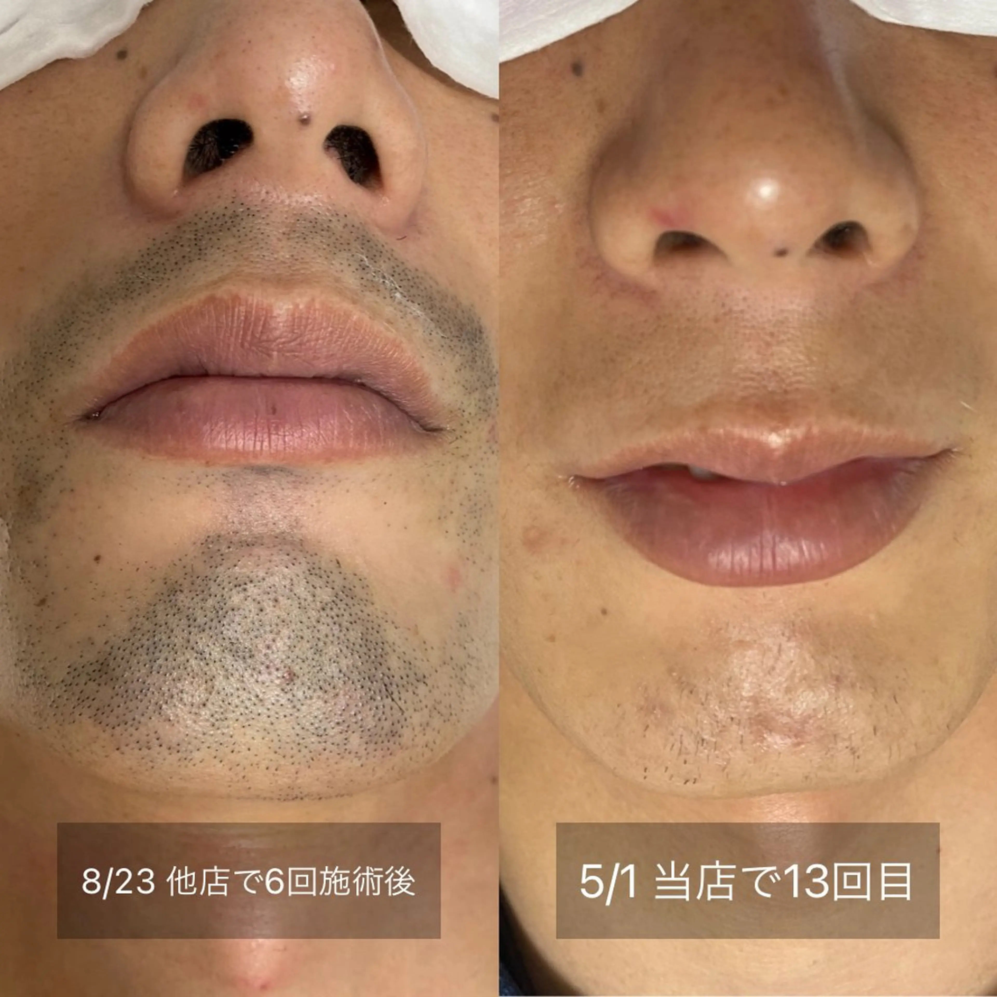 メンズ 港区都度払い脱毛 miranjuのエステ・リラクイメージ