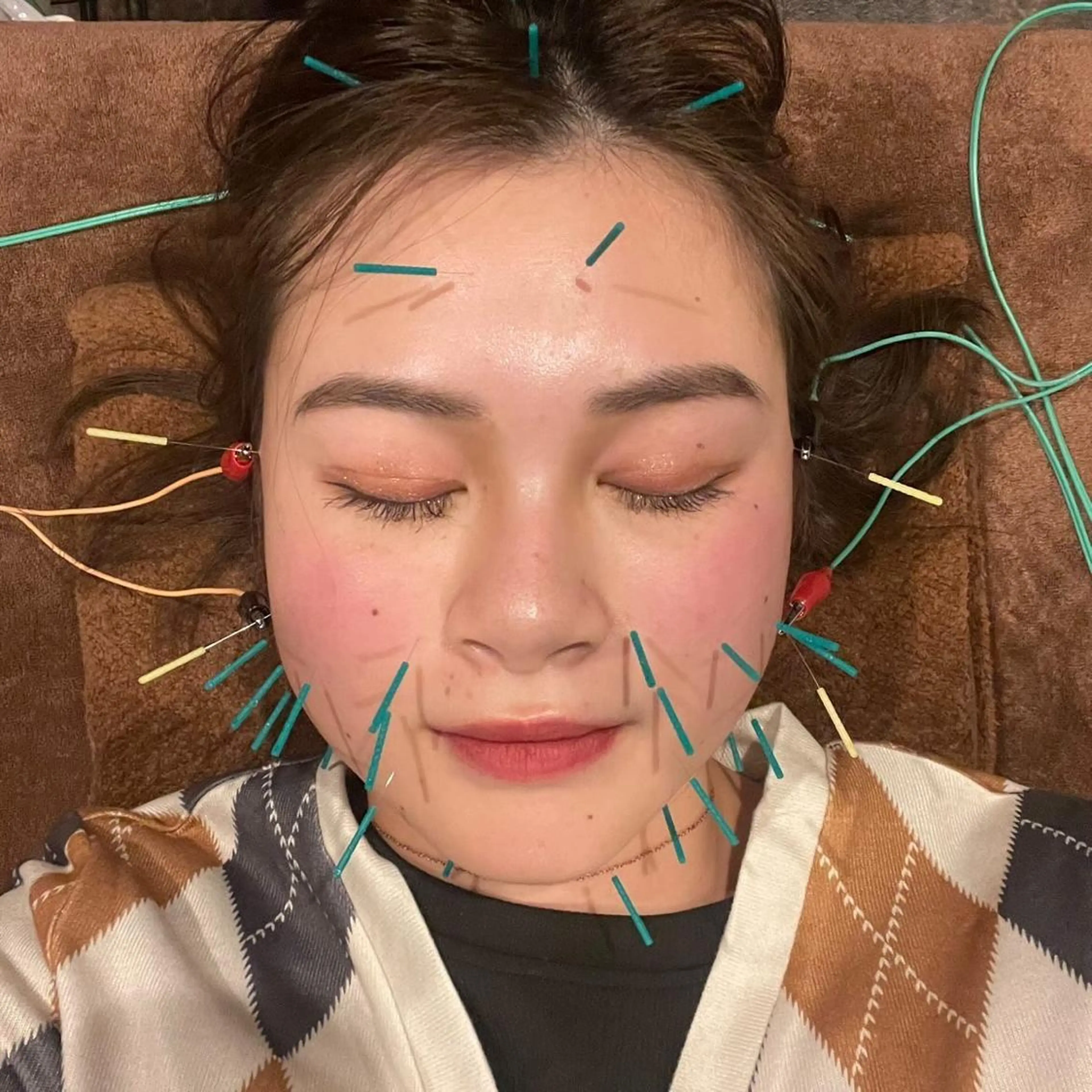 ⭐️100本美容鍼⭐️ シワ、たるみ、浮腫など広範囲に取りたい方！ミニモ特別価格❗️の写真