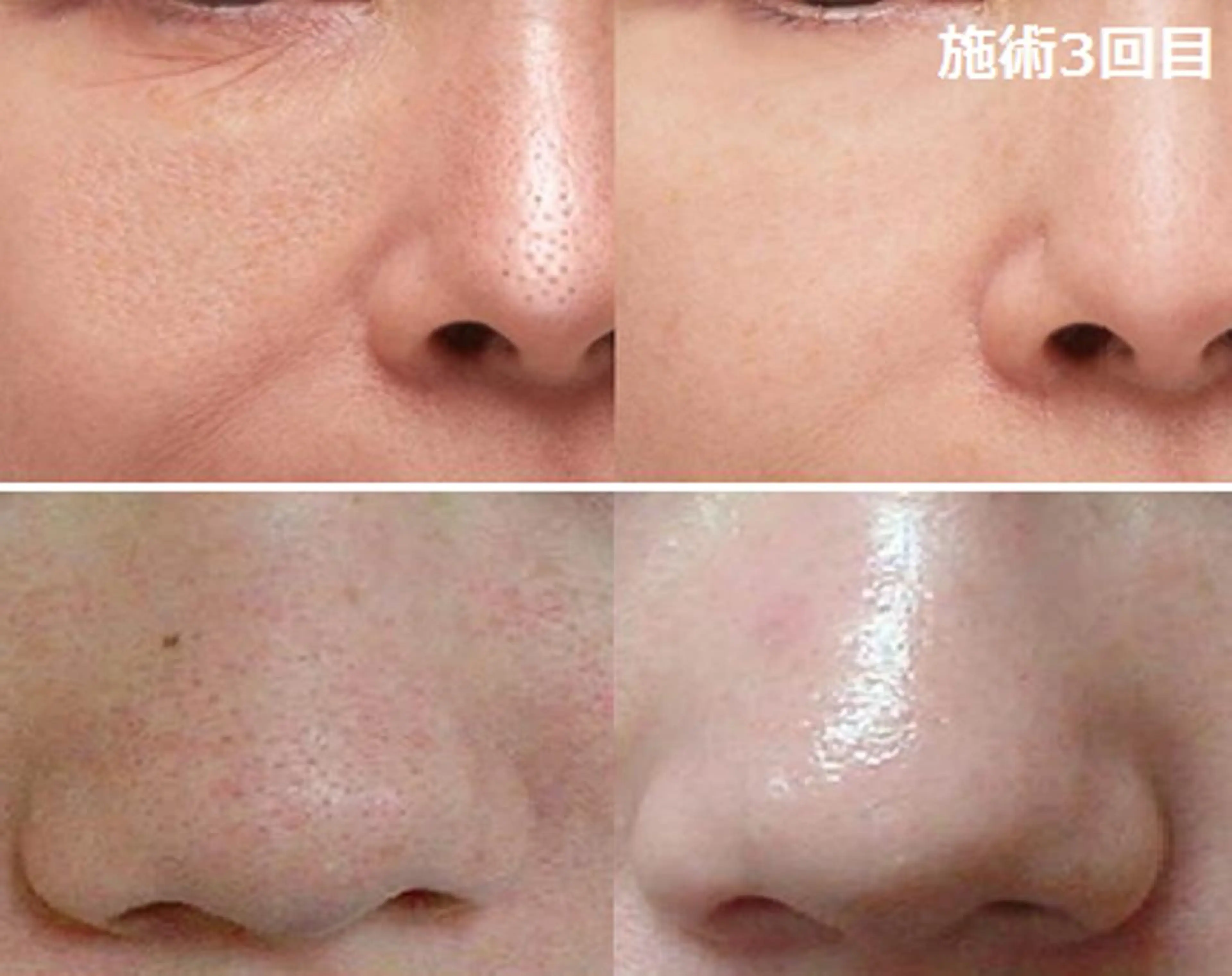 エステ 顔脱毛&毛穴&ニキビ 優良№1♪ヒロコ♪のエステ・リラクイメージ