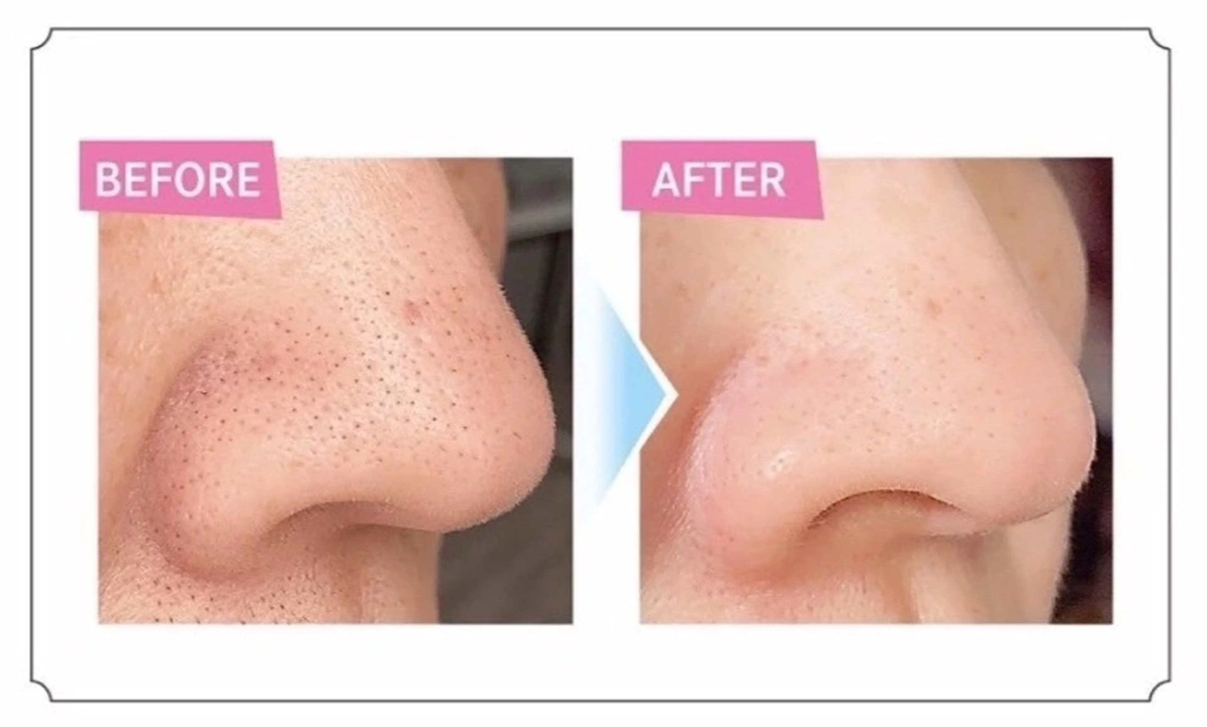 【毛穴洗浄】🎓ミニモ学割🎓毛穴撃退＋幹細胞ケア🪞🫧▫️黒ずみ▫️ざらつき▫️くすみ▫️乾燥  🧢メンズOKの写真