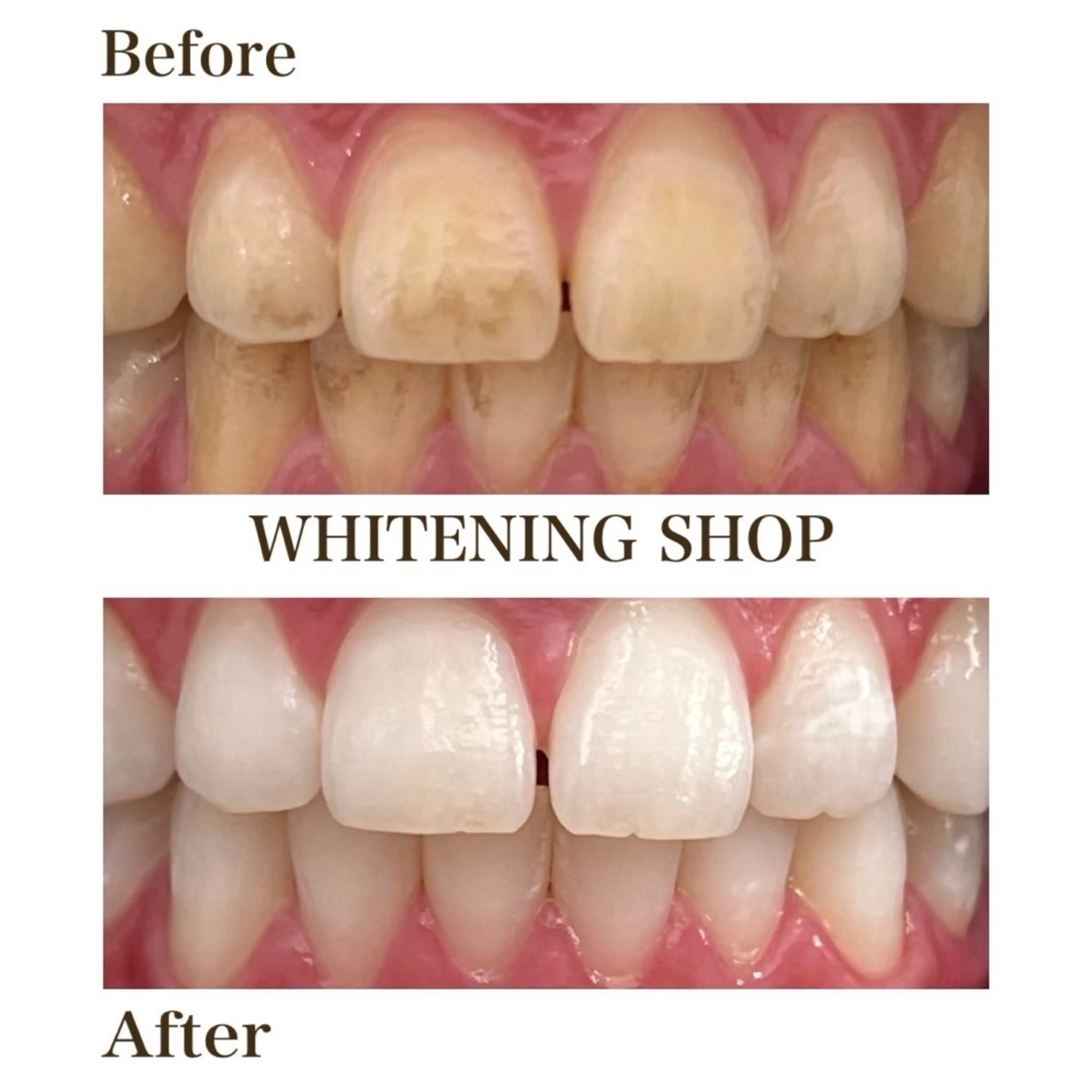 【新規限定】初回2回集中“白さ実感”ホワイトニングプログラム｜40分×2dayチケットの写真