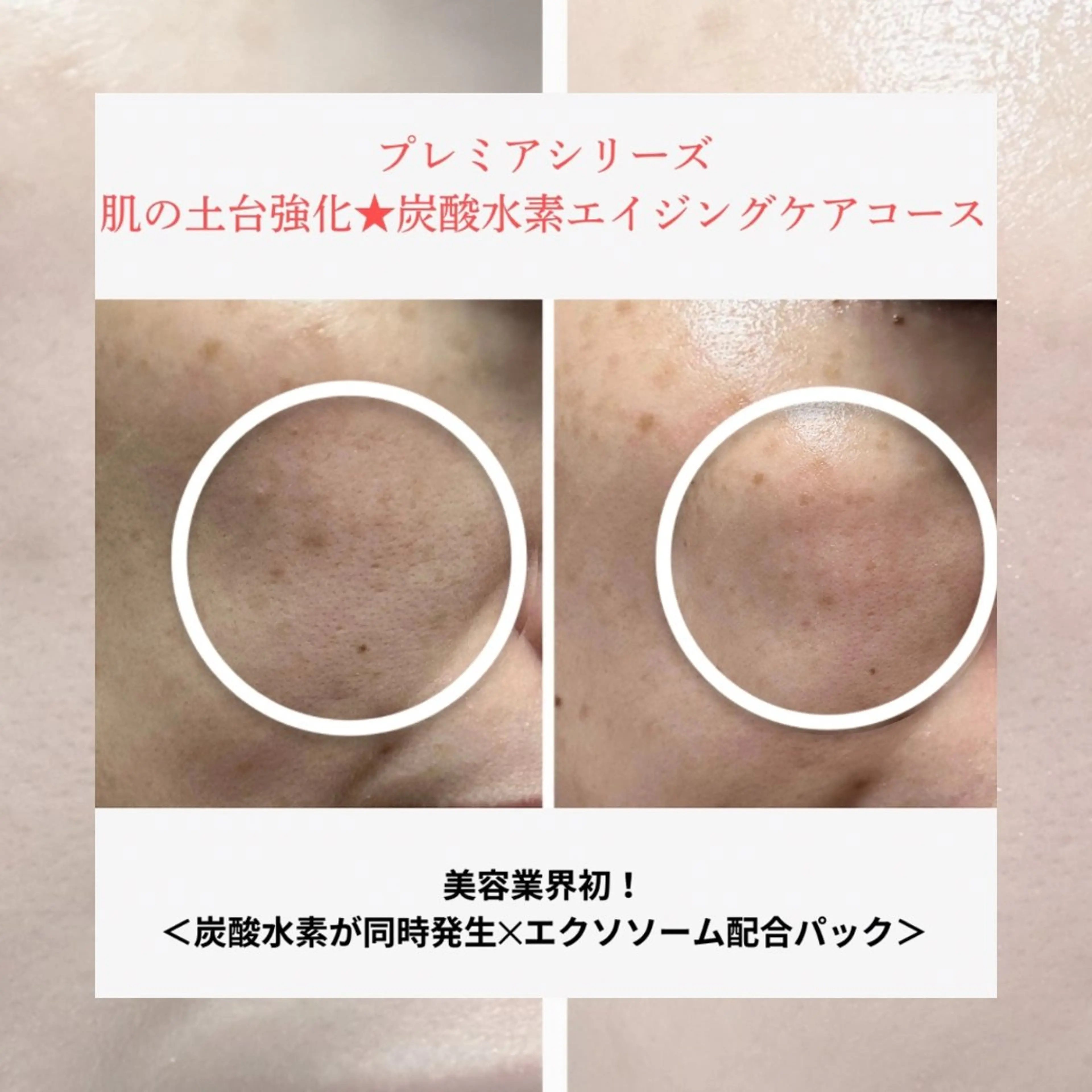 肌の土台強化★炭酸水素エイジングケアメニューの写真