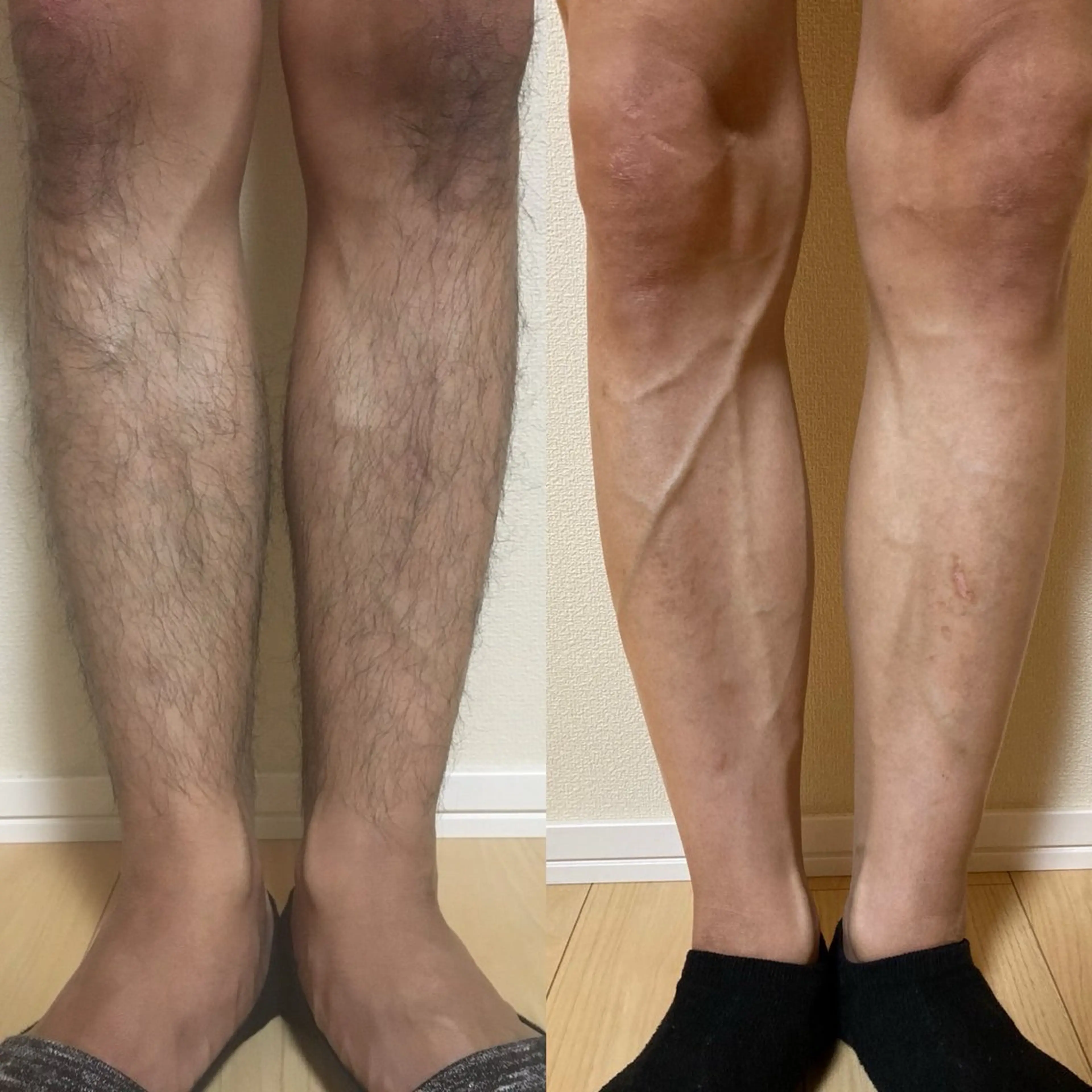 【見た目スッキリスベスベ】全身脱毛（顔VIO無し）の写真