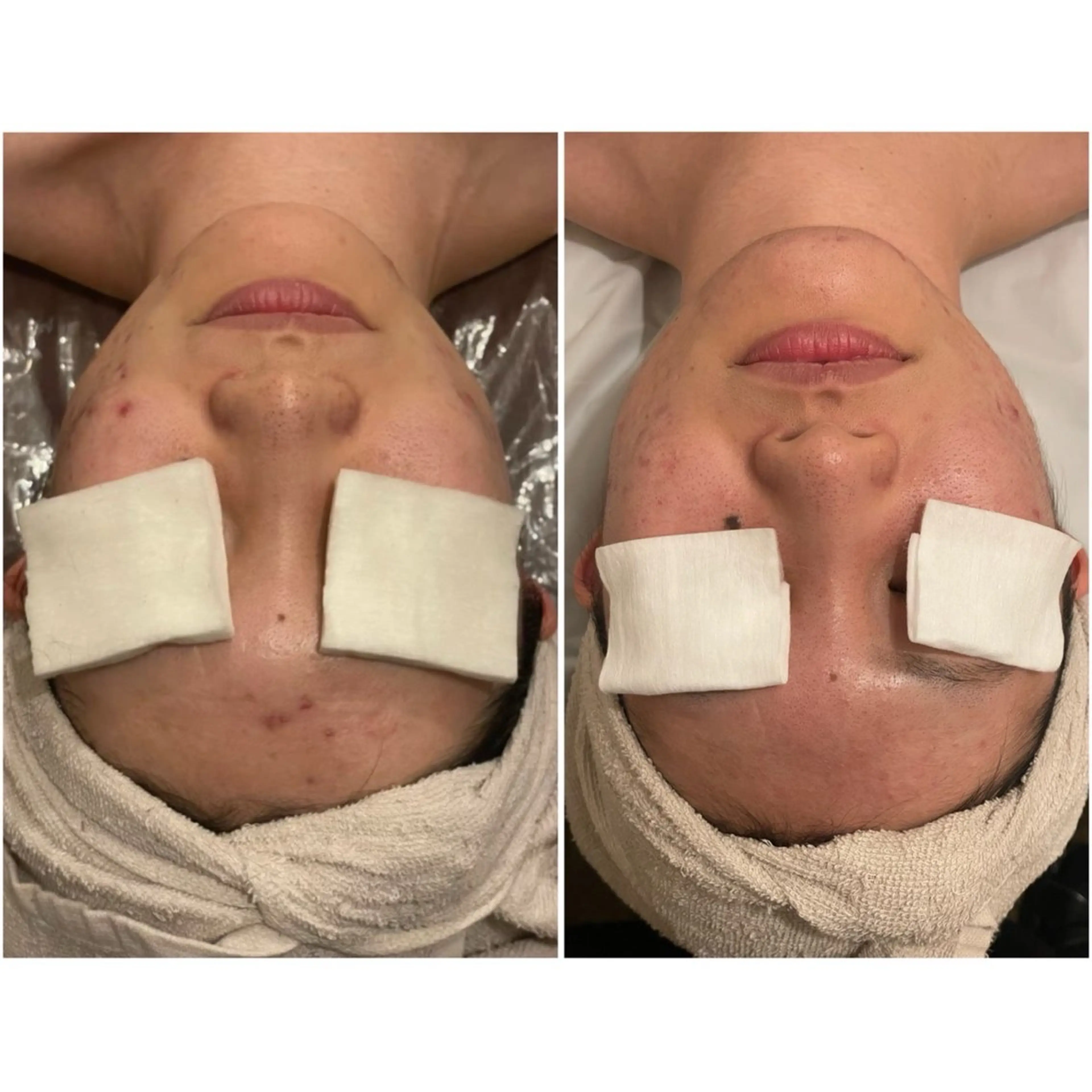 ミニモ限定🩵２０代限定フェイシャルエステモニター【顔のむくみ、肩こりが気になる方におすすめ】小顔フェイシャルの写真