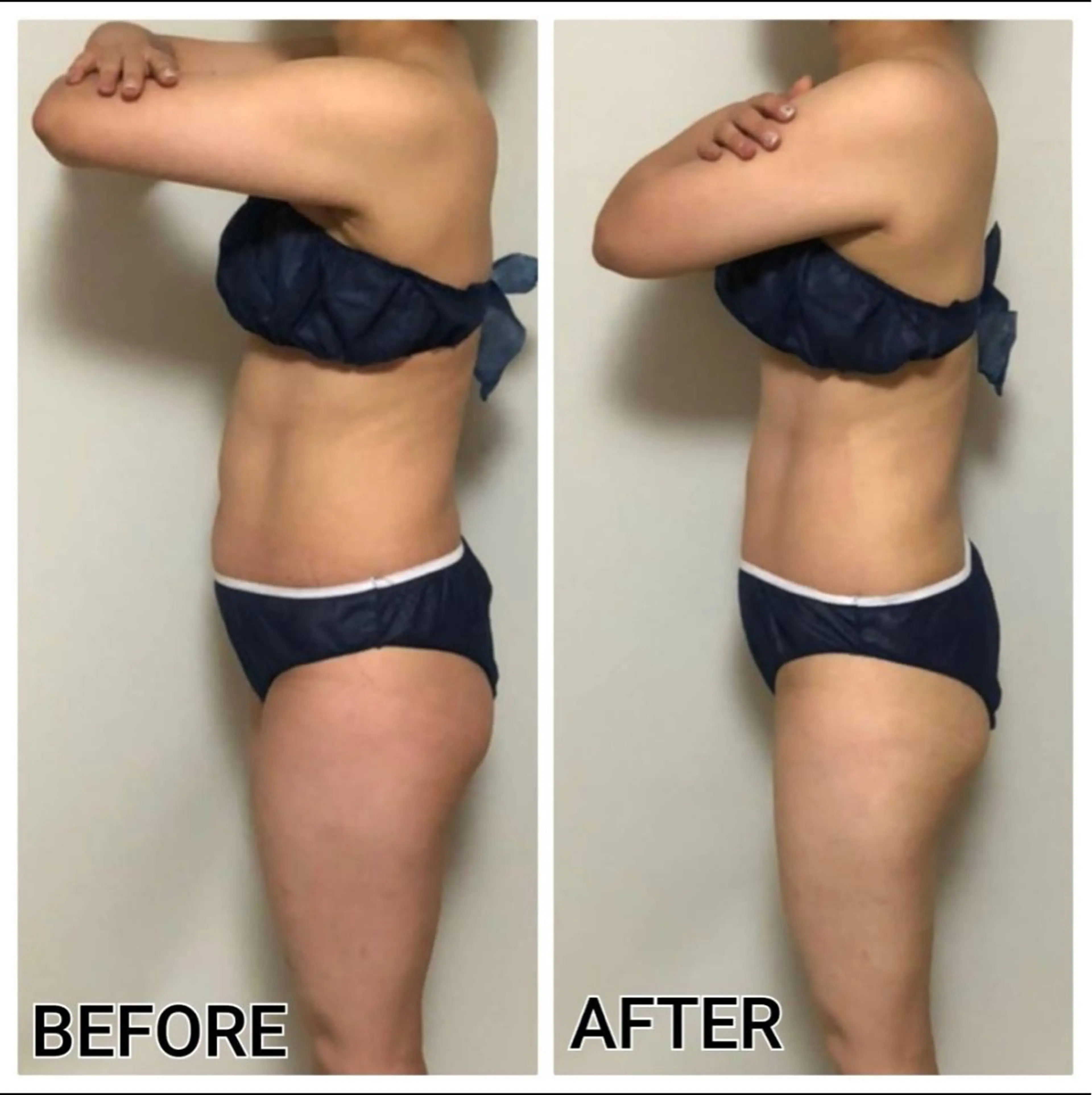 お腹痩せ❣️痛みなし❣️の写真