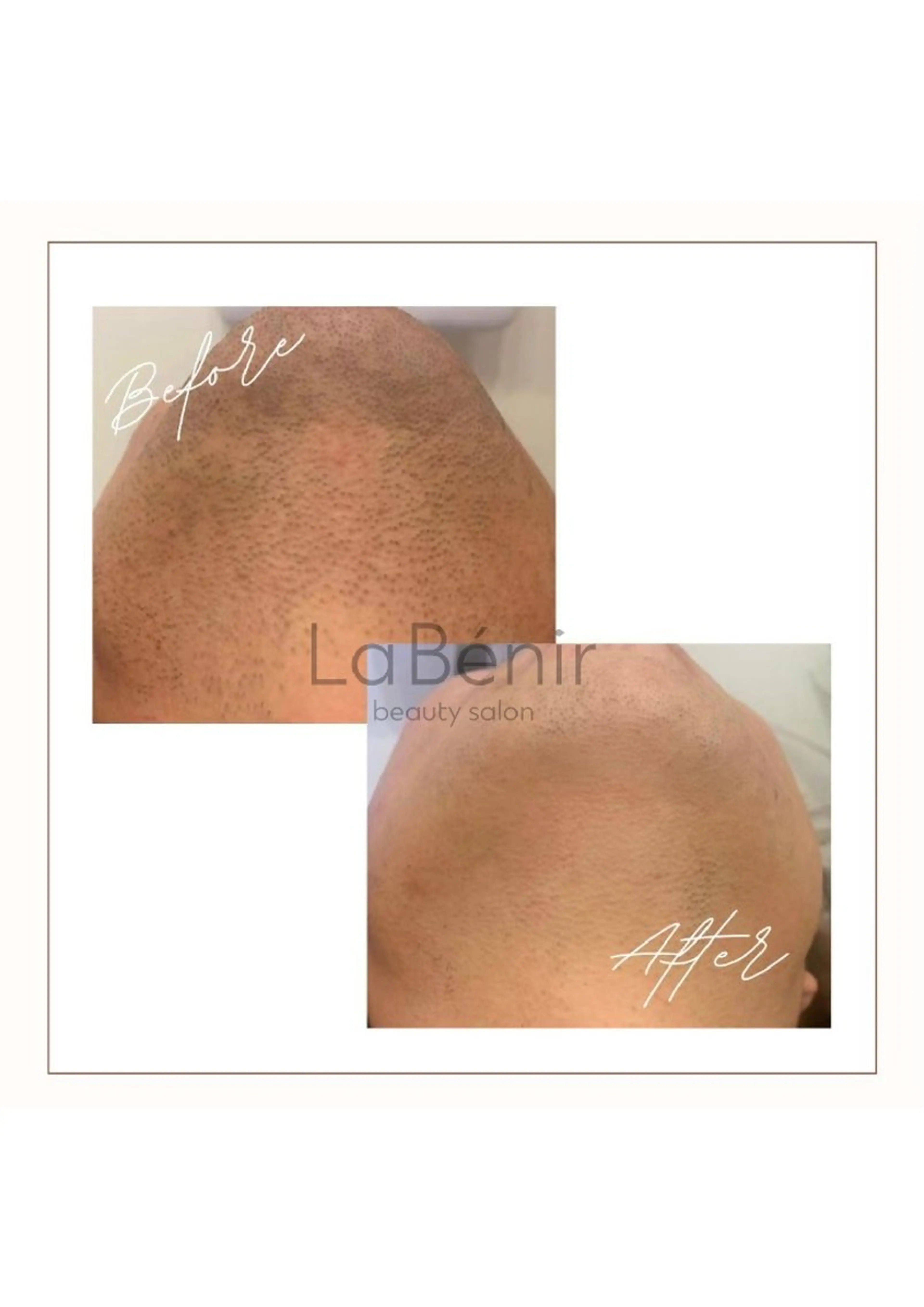 メンズ エステ 脱毛/美肌【皮膚科看 護師経営】ラベニールのエステ・リラクイメージ