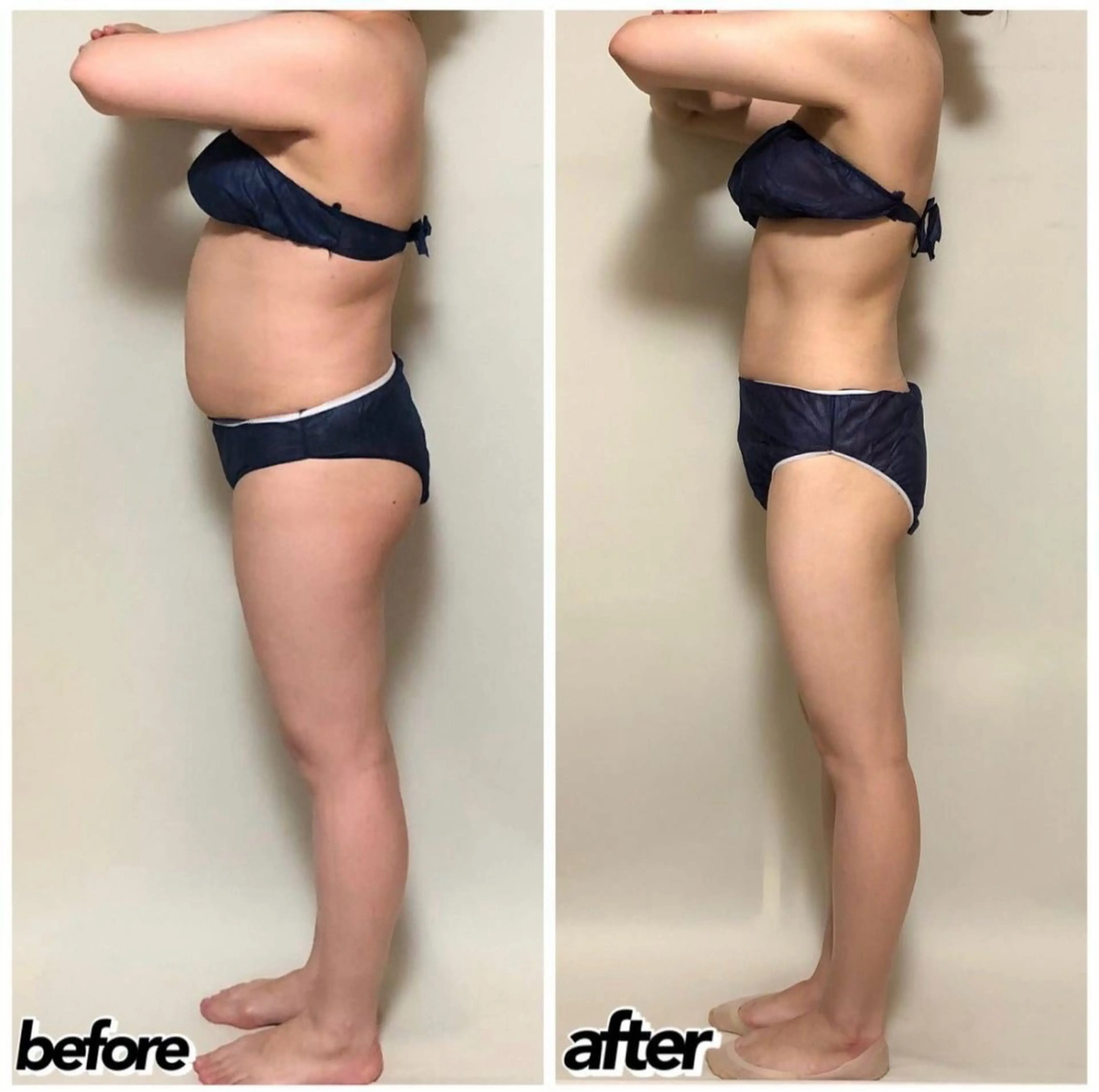 全身痩身エステ(お腹・背中・二の腕・ヒップ・太もも・ふくらはぎ)❣️機械を使用いたします😌の写真