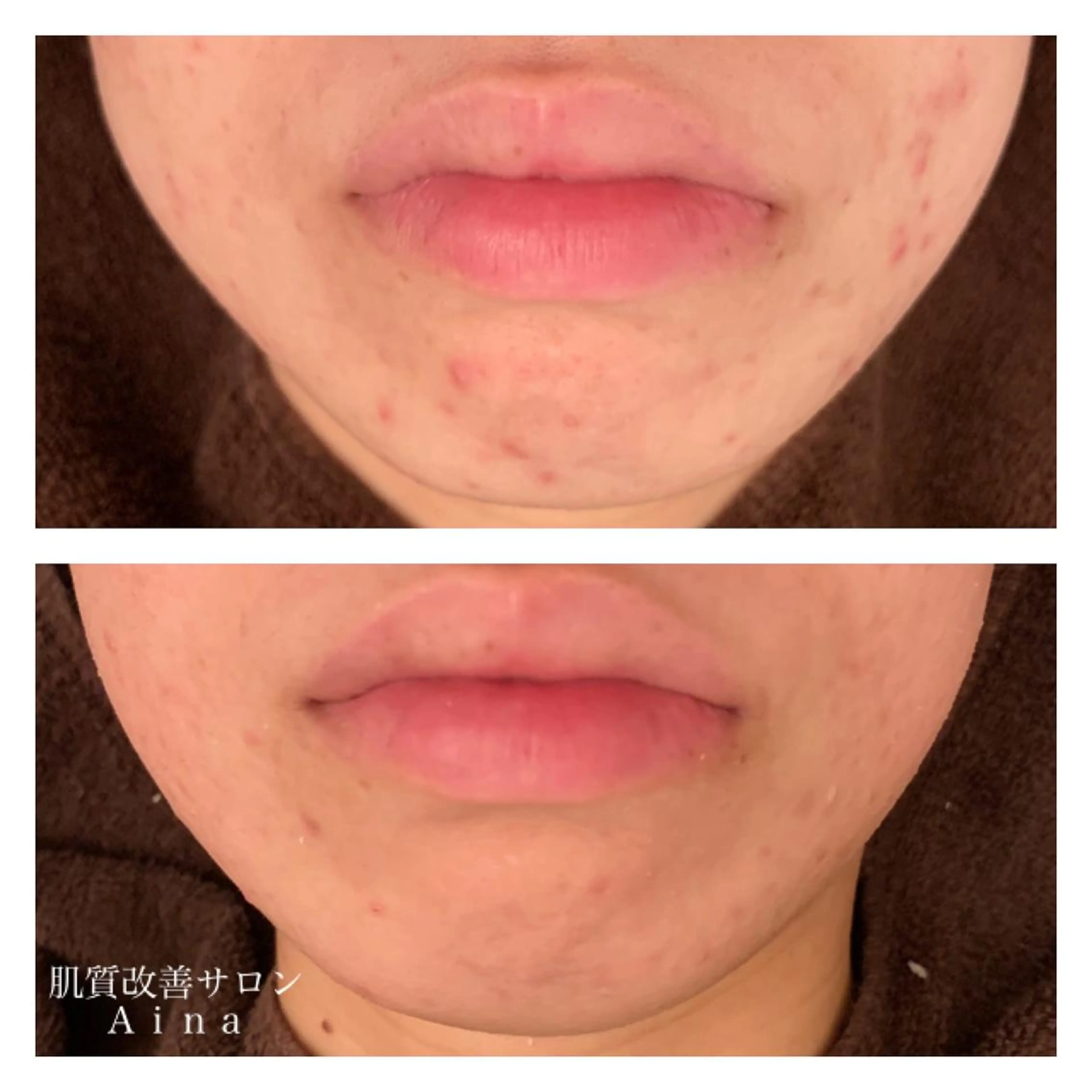 ショート カラー パーマ ヘアアレンジ メンズ キッズ ネイル マツエク・マツパ ニキビ跡専門サロン Ainaのエステ・リラクイメージ