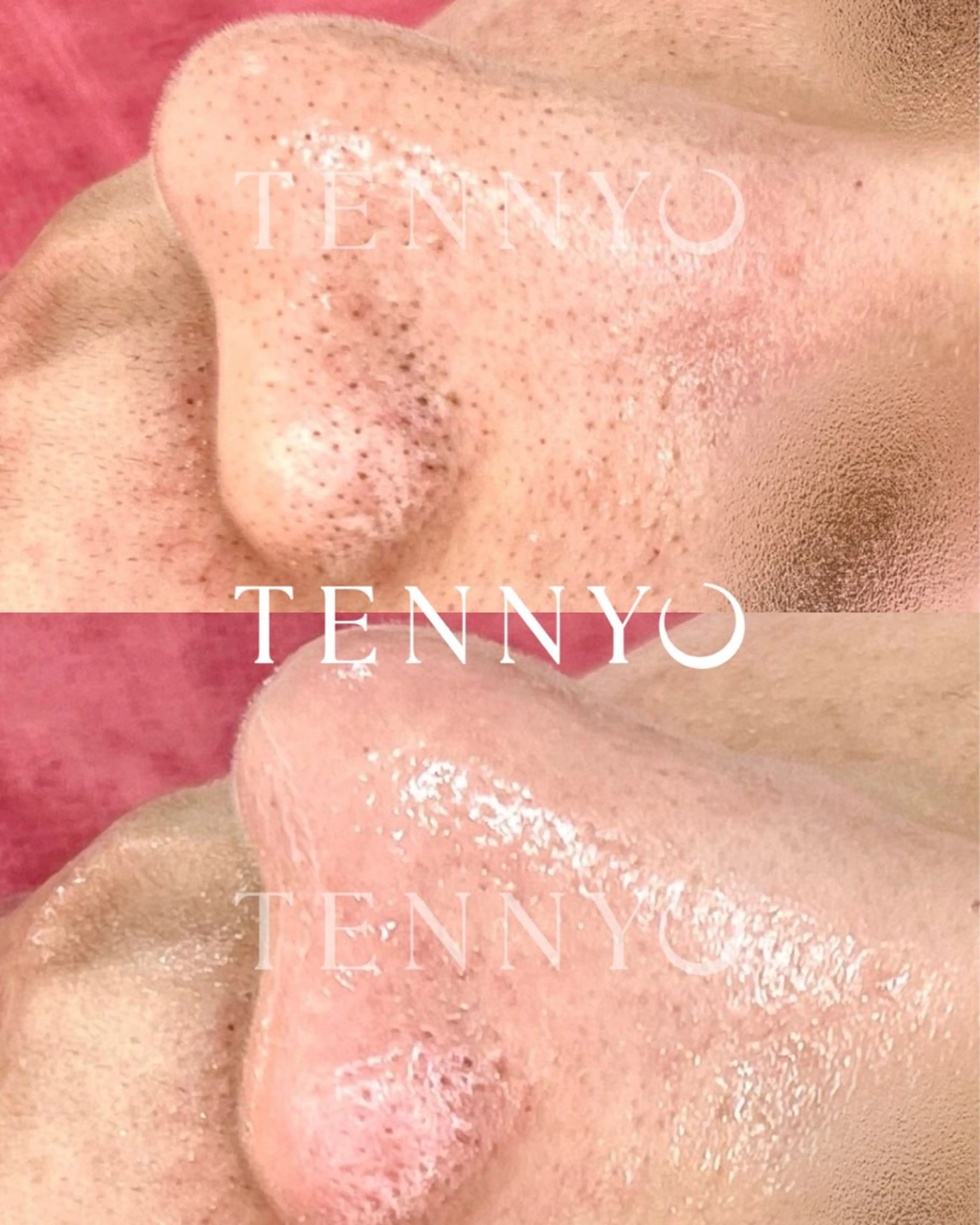 【男性限定】いちご鼻TENNYO毛穴洗浄◆15400→の写真