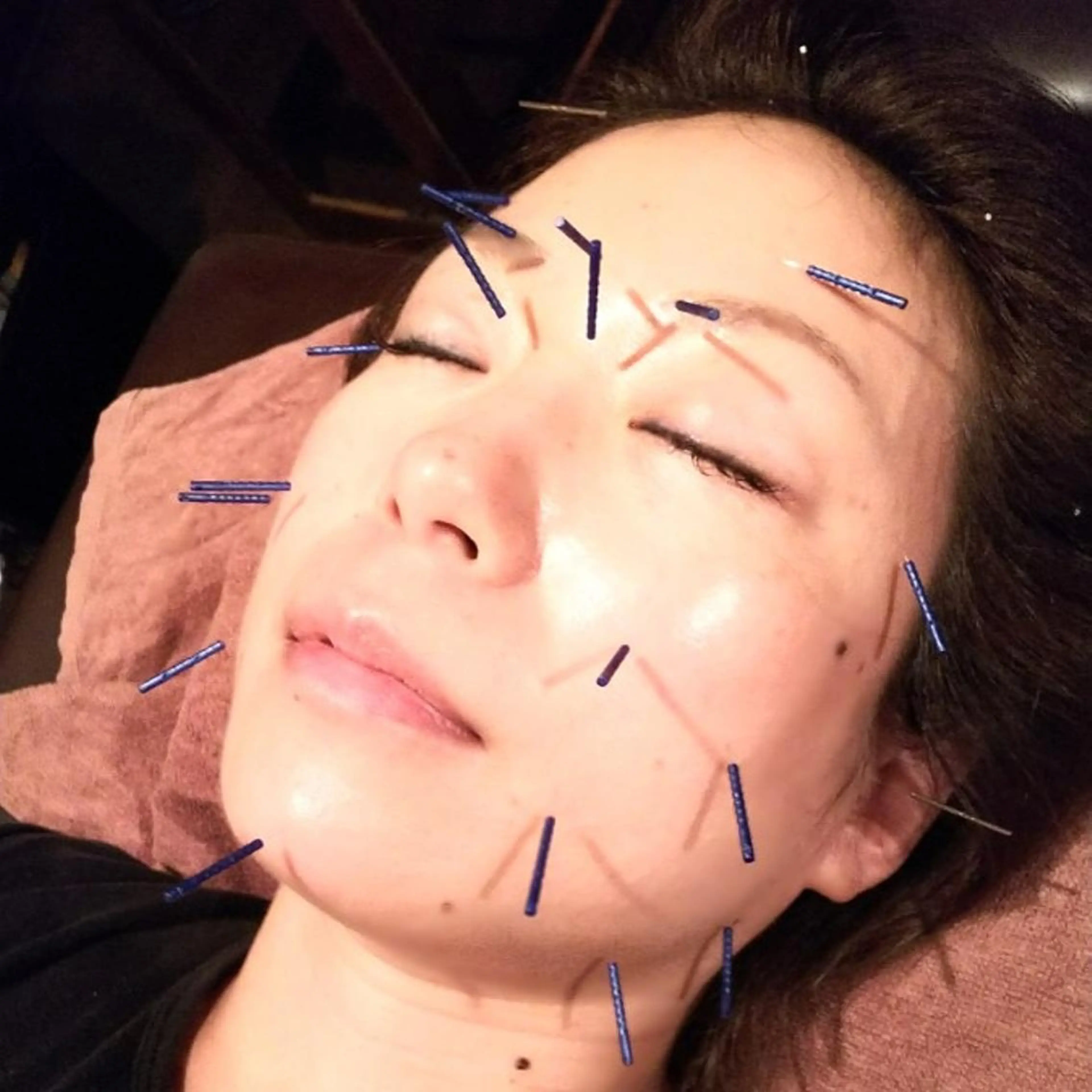 むくみたるみ専門☆ 美容鍼・小顔矯正のエステ・リラクイメージ