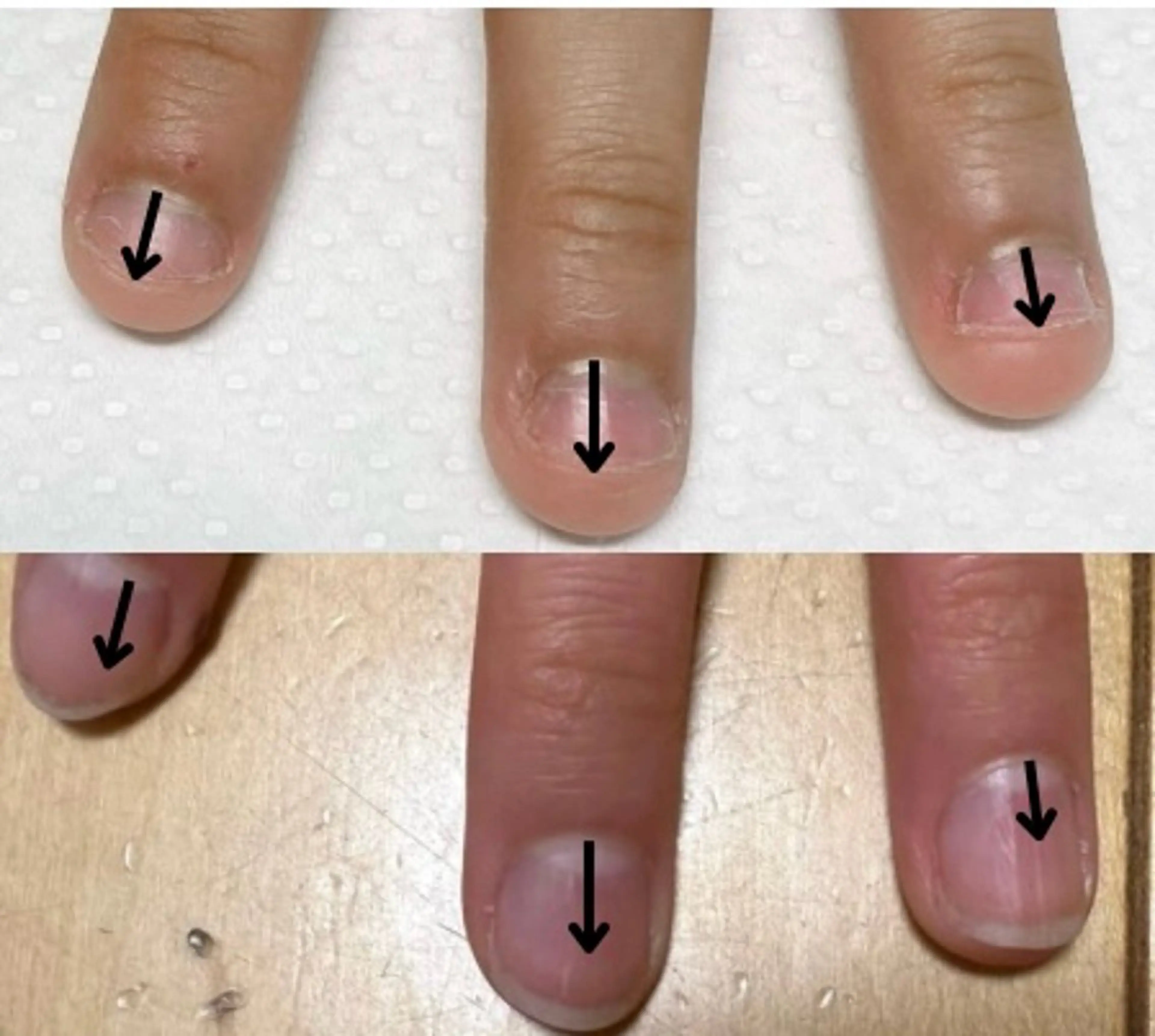 【深爪ケア】噛み癖、むしり癖などお悩みのある方向けのメニューですの写真