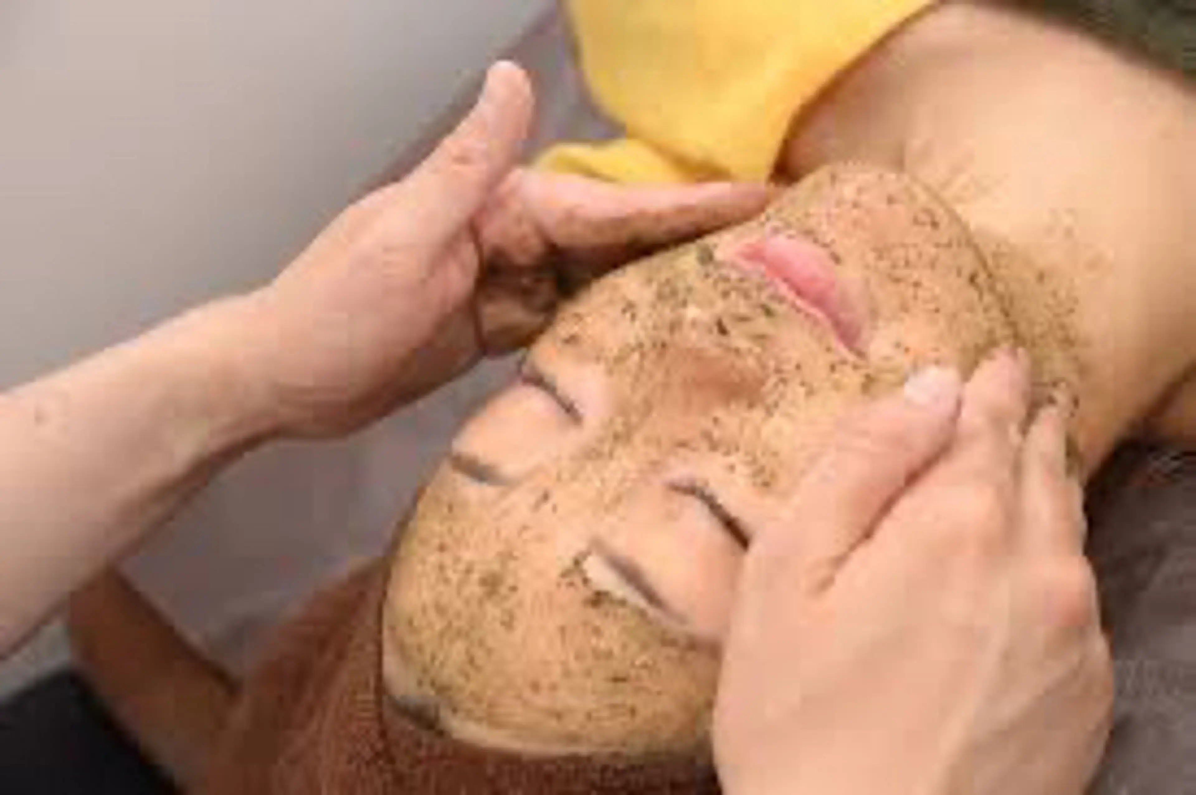 【 口コミ必須/メンズも歓迎⭐️ 】当日🆗 ハーブピーリング⭐️スピキュールが多量🌿軽い剥離有り・ダウンタイム4日の写真