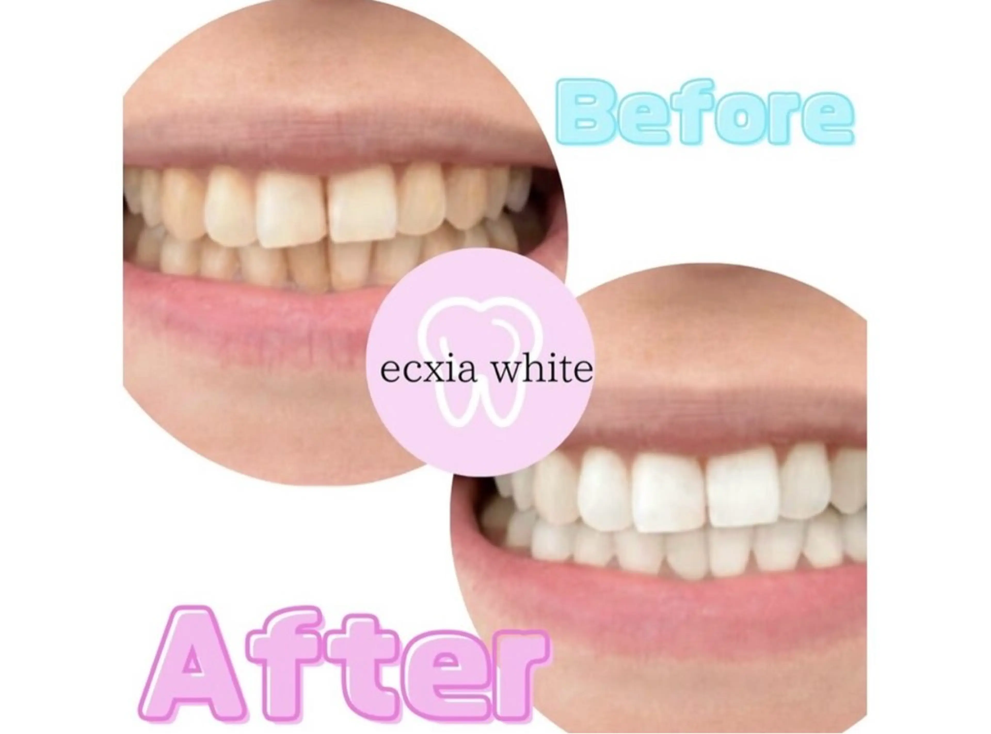 セルフホワイトニングの写真