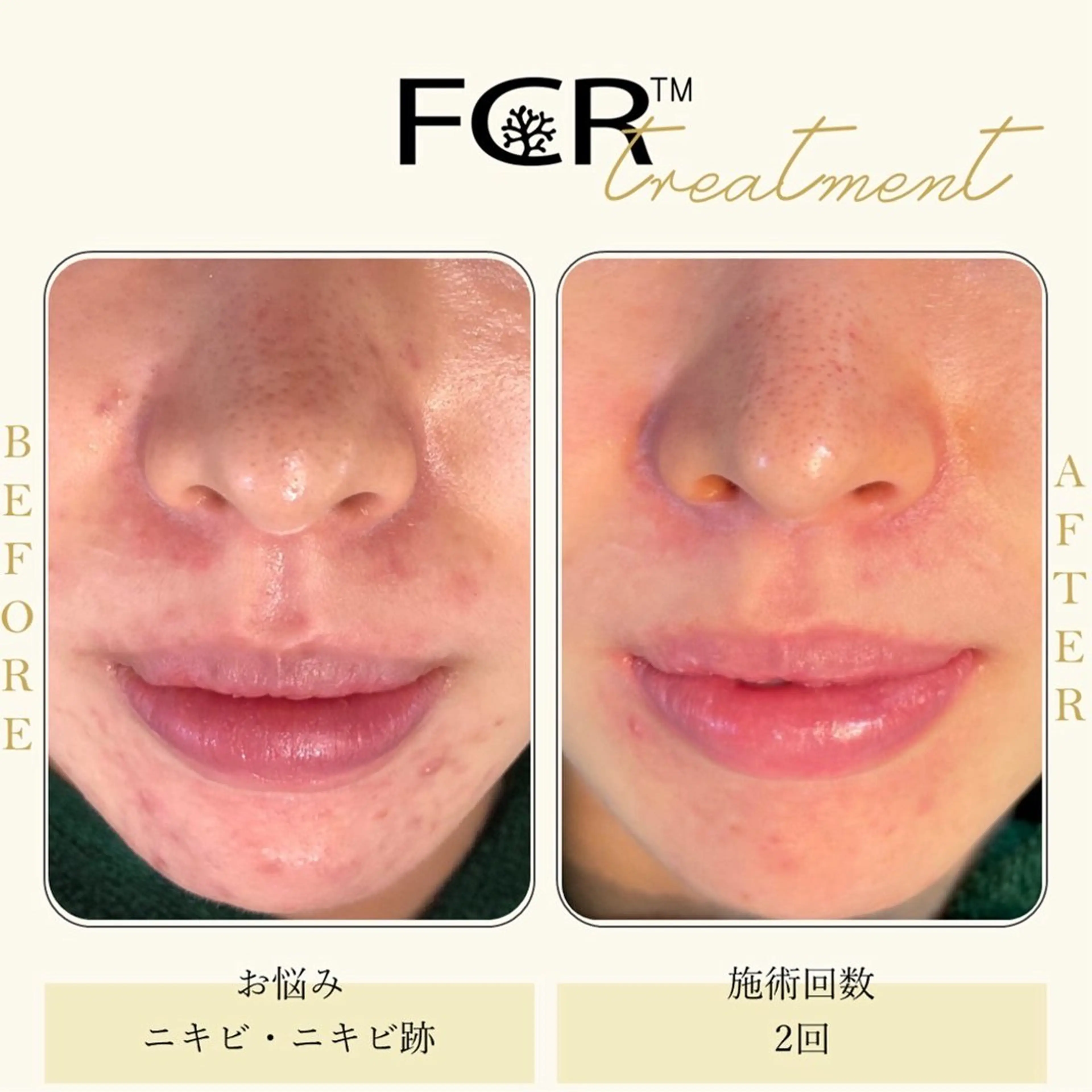 ニキビ改善シャルム ココハーブピーリングのエステ・リラクイメージ