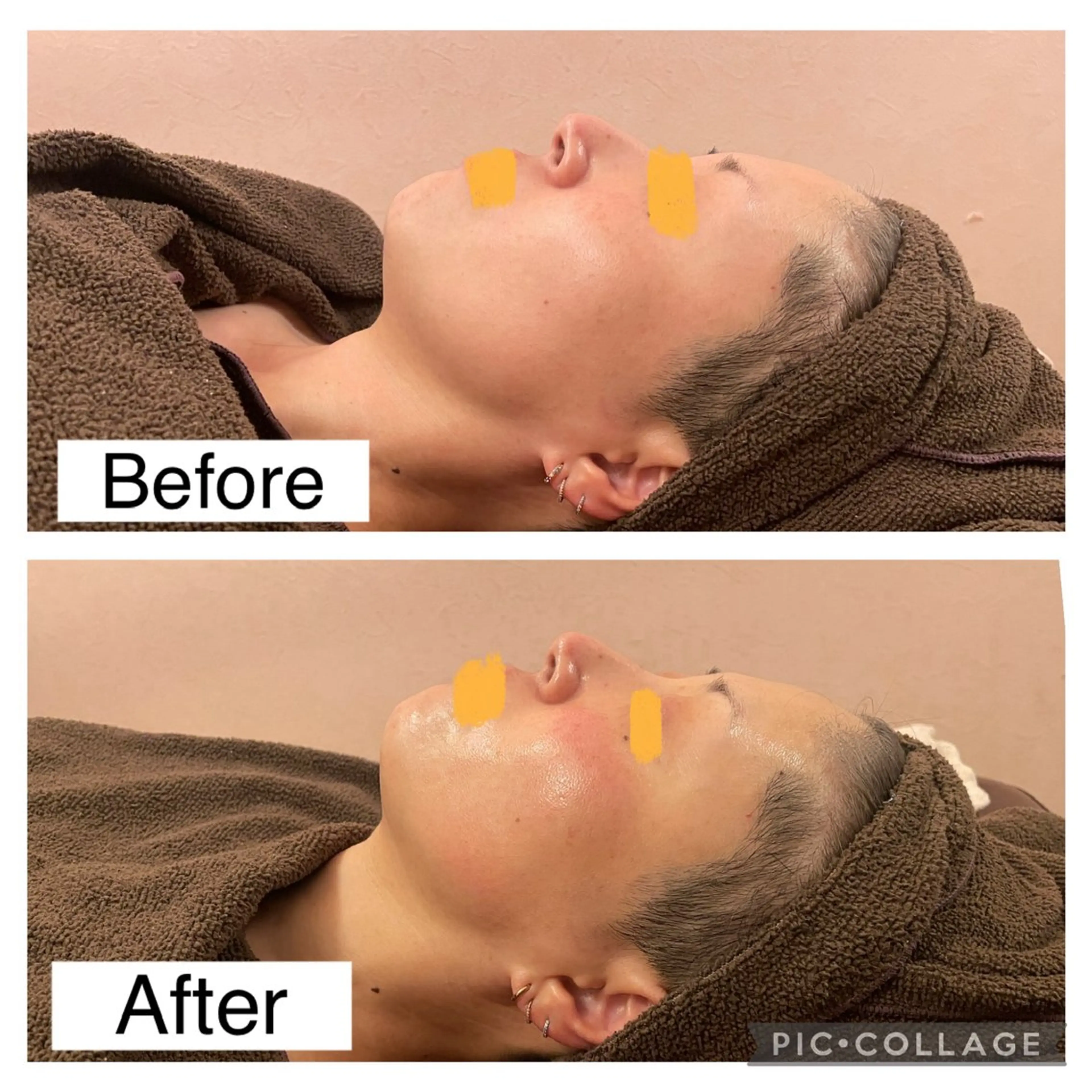 【毛穴/小顔/ニキビ/むくみ】ハイドラフェイシャル(毛穴洗浄)+プラズマ+ヒト幹細胞美容液導入+EMS×RF計60分の写真