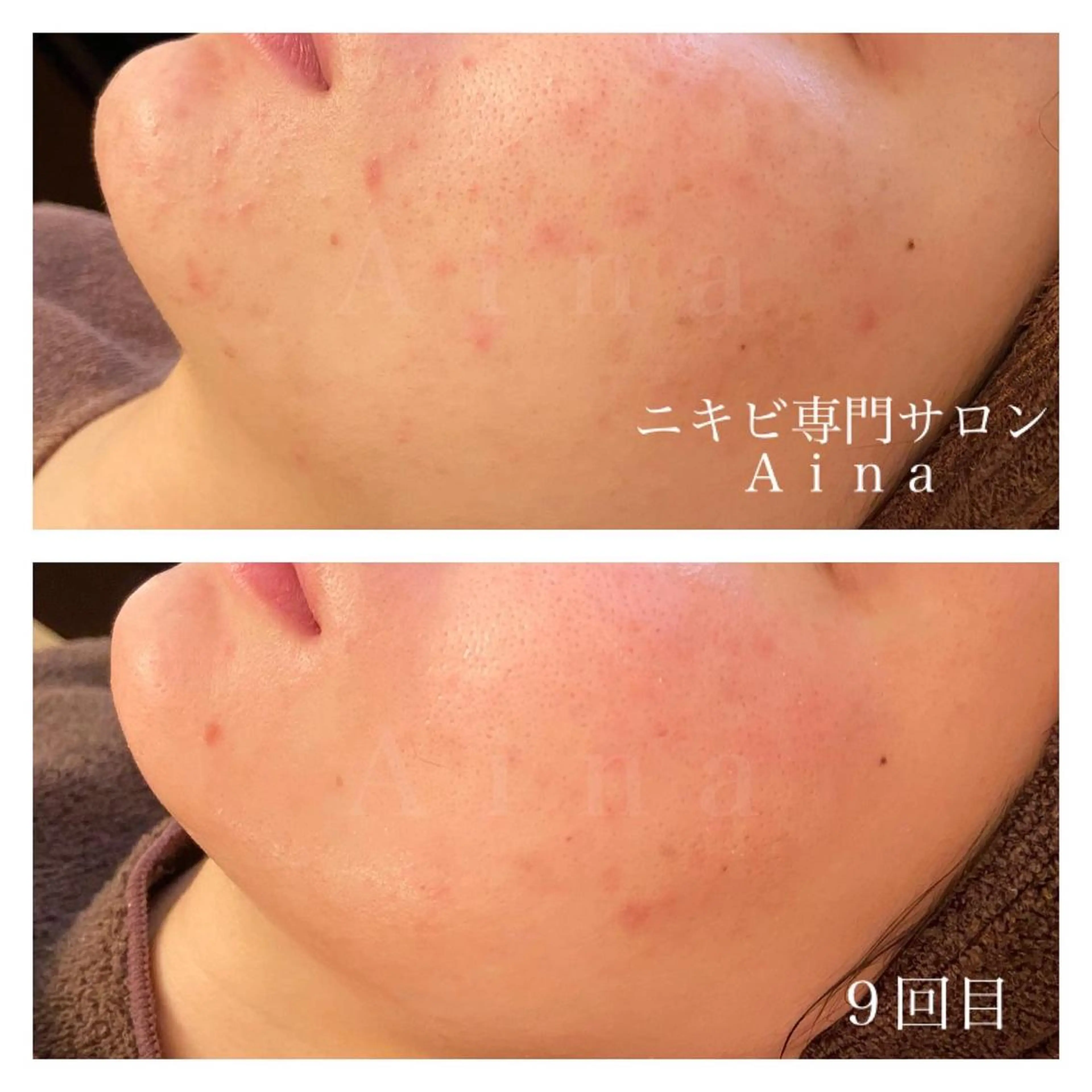 ミディアム カラー パーマ ヘアアレンジ メンズ キッズ ネイル マツエク・マツパ 学生（メンズ向け） 学生 ニキビ跡専門サロン Ａｉｎａのエステ・リラクイメージ