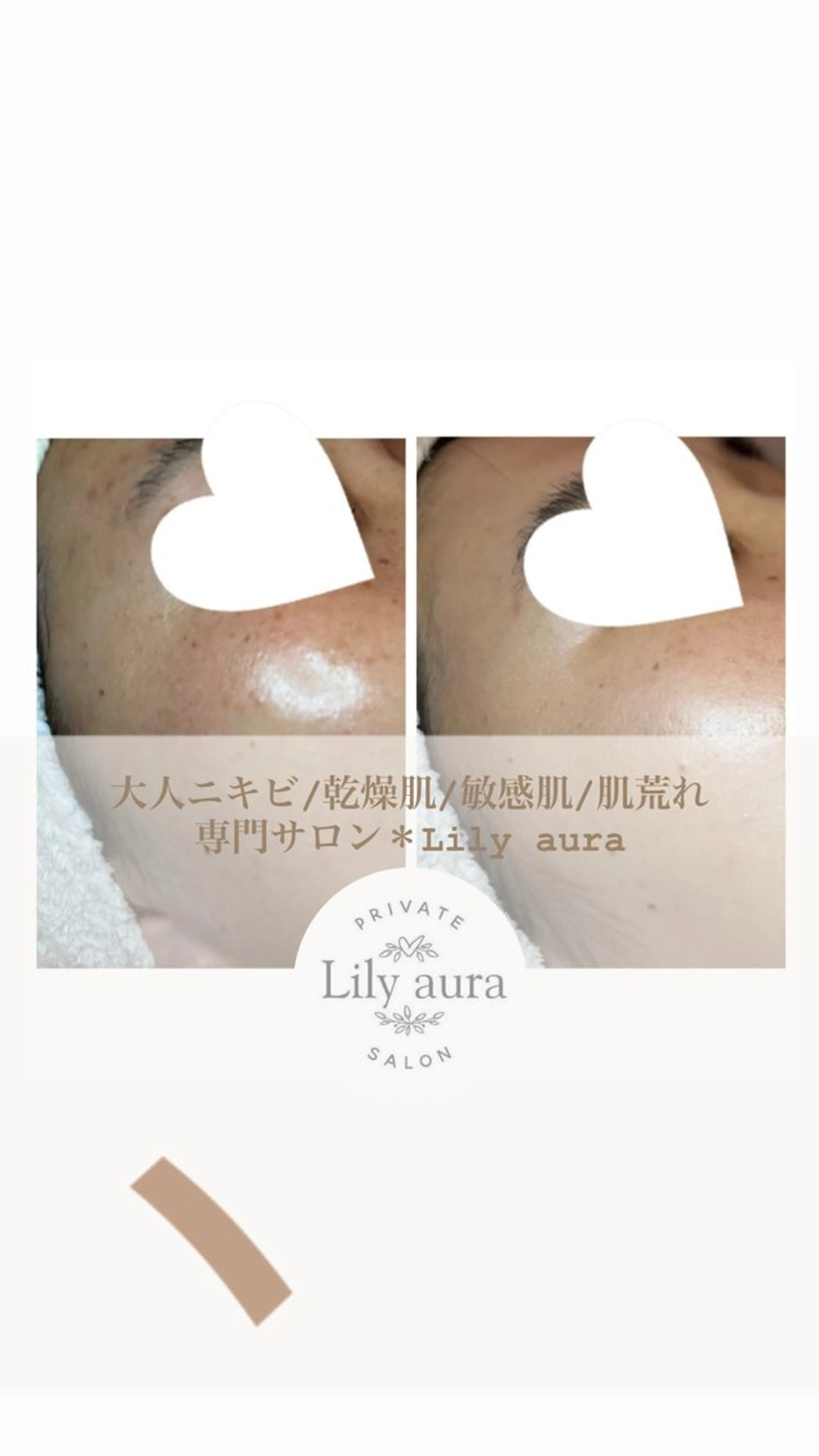エステ ニキビ/敏感肌/乾燥 Lilyauraのエステ・リラクイメージ