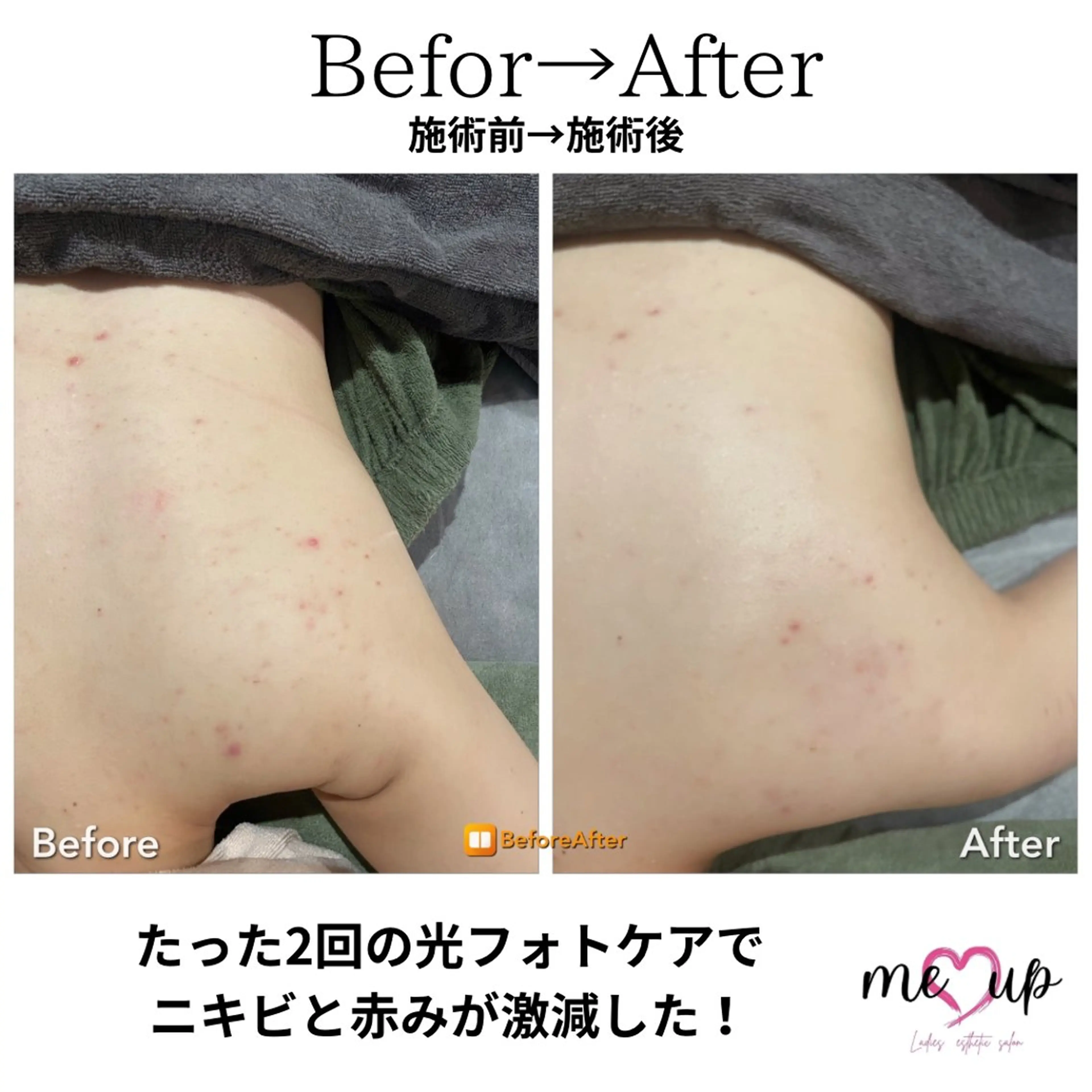 エステ Meupニキビ専門店 背中/ハーブ/肌管理のその他イメージ