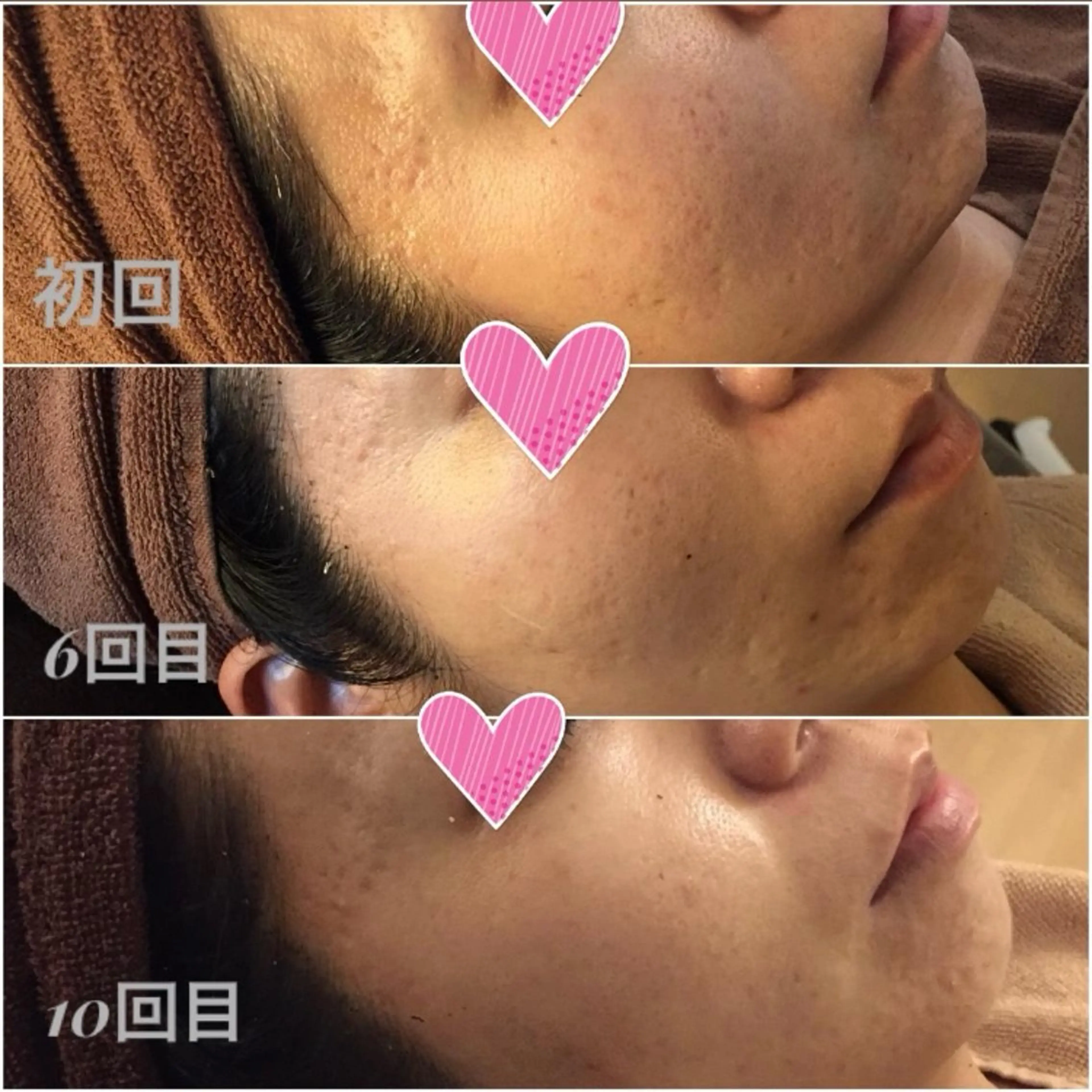 エステ 毛穴ニキビ専門 ビューティーグランツのエステ・リラクイメージ