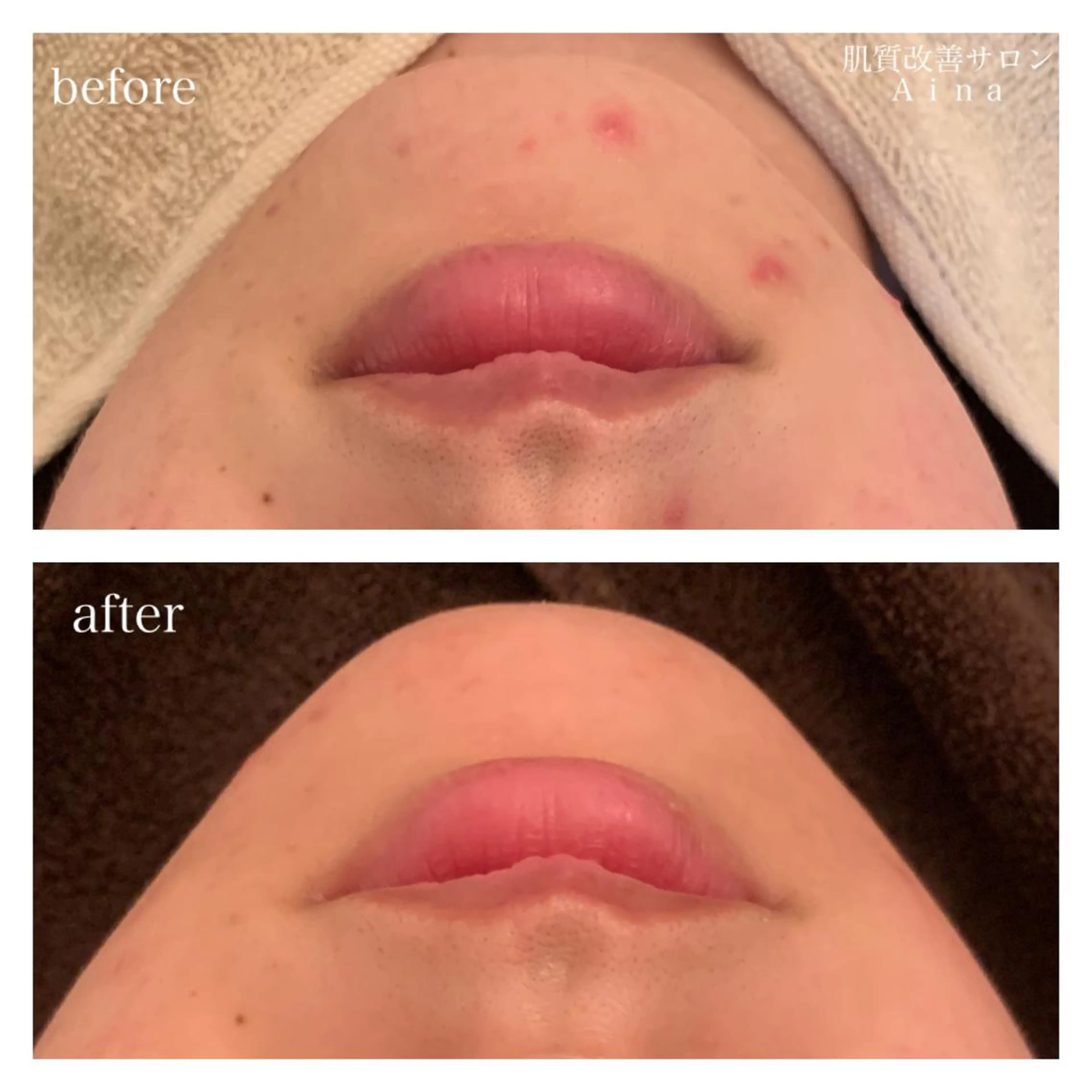 ロング カラー パーマ ヘアアレンジ メンズ キッズ ネイル マツエク・マツパ エステ リラク ニキビ跡専門サロン Ａｉｎａのエステ・リラクイメージ