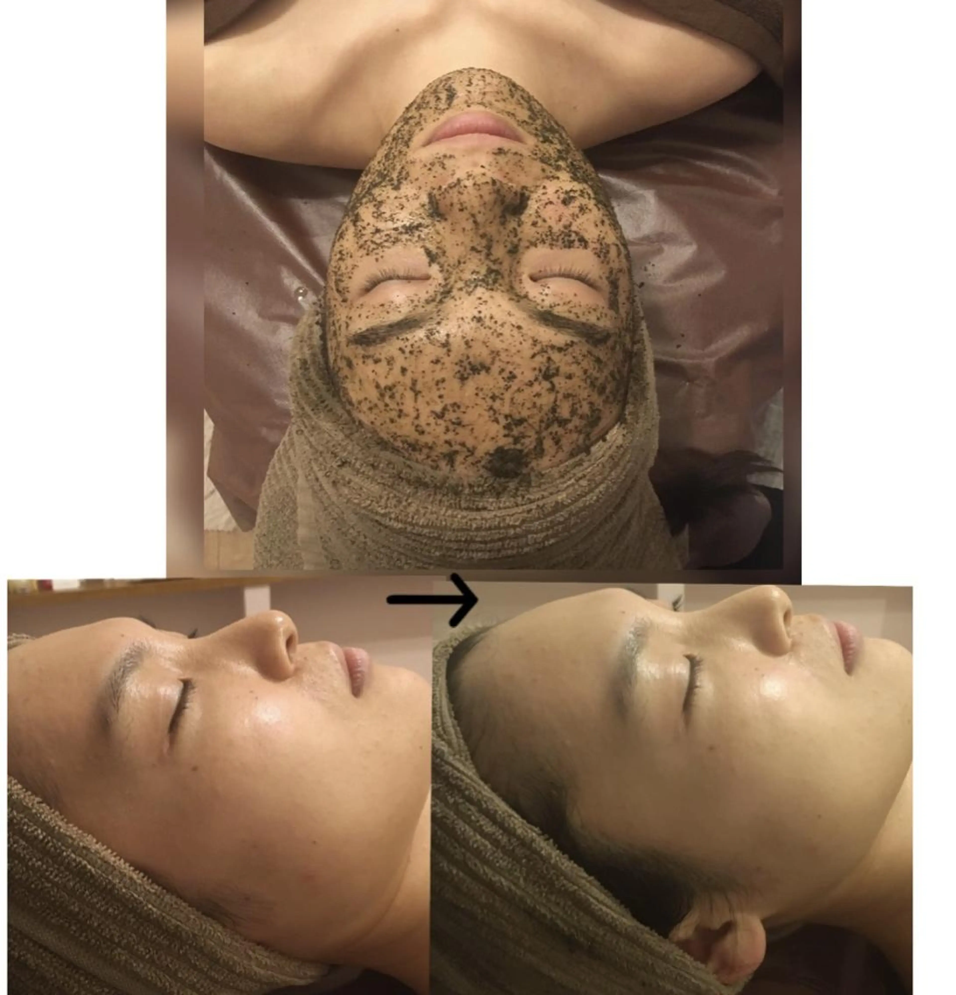 エステ ニキビ・毛穴改善 🌿ハーブピーリングのエステ・リラクイメージ