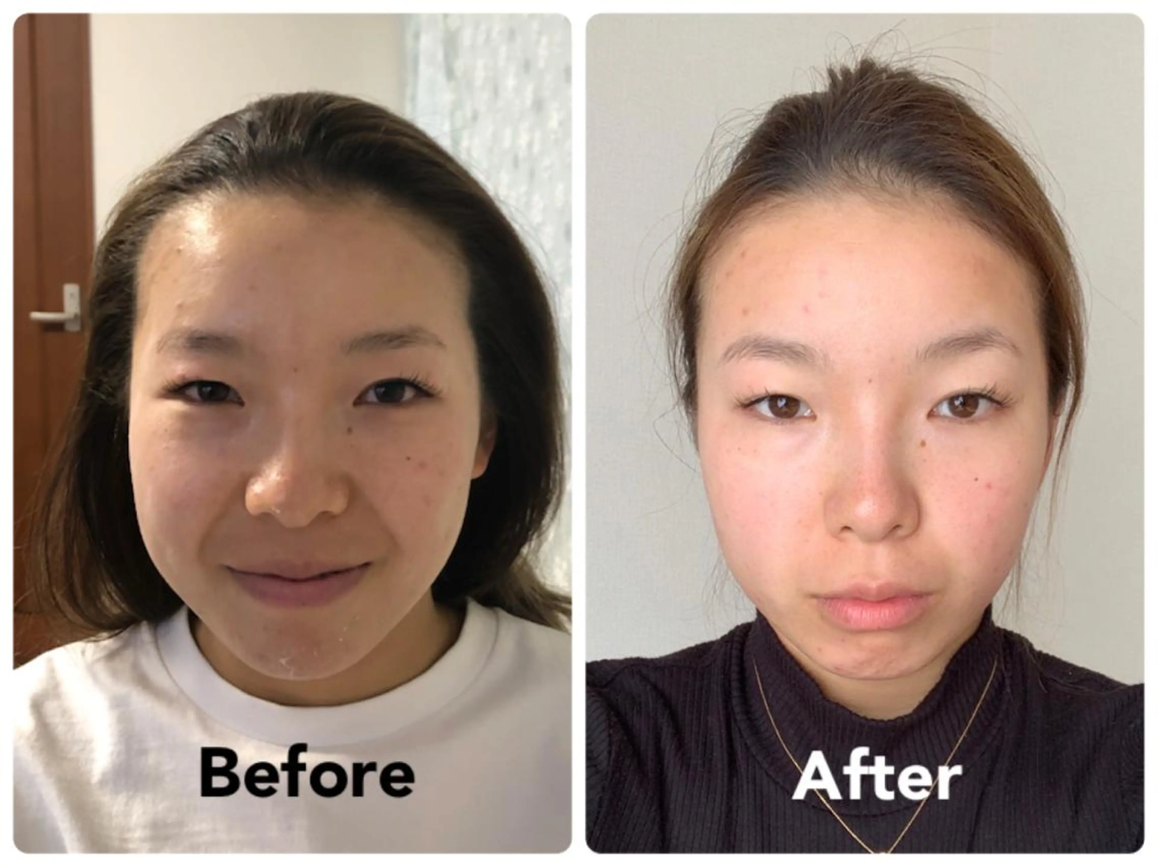 ☘️写真提供モニター募集☘️痛くない小顔矯正で、あなたのお悩みを解消します。たるみ、ほうれい線が気になる方お願いしますの写真