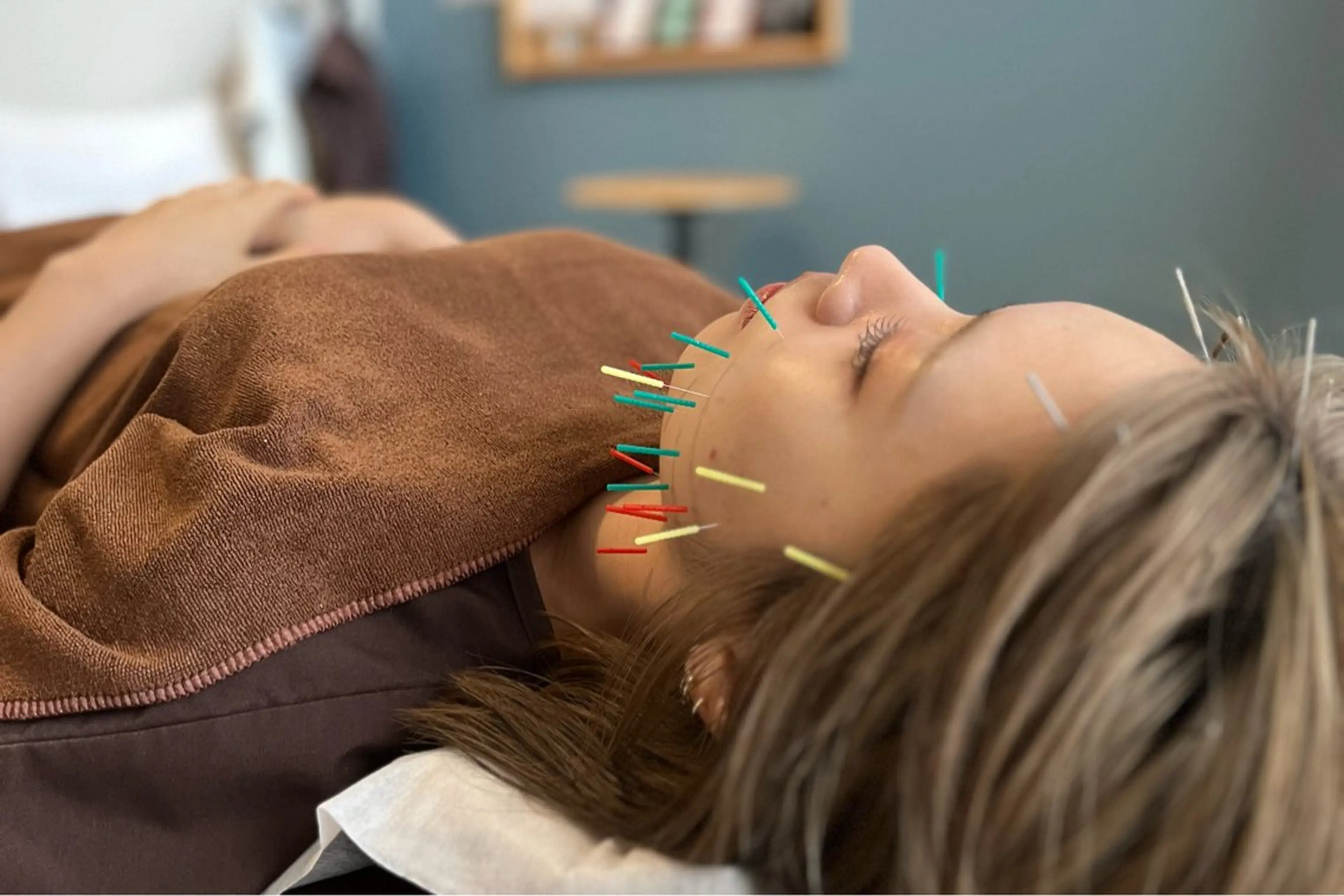 美容鍼(スペシャル)・首肩ヘッドマッサージ付の写真