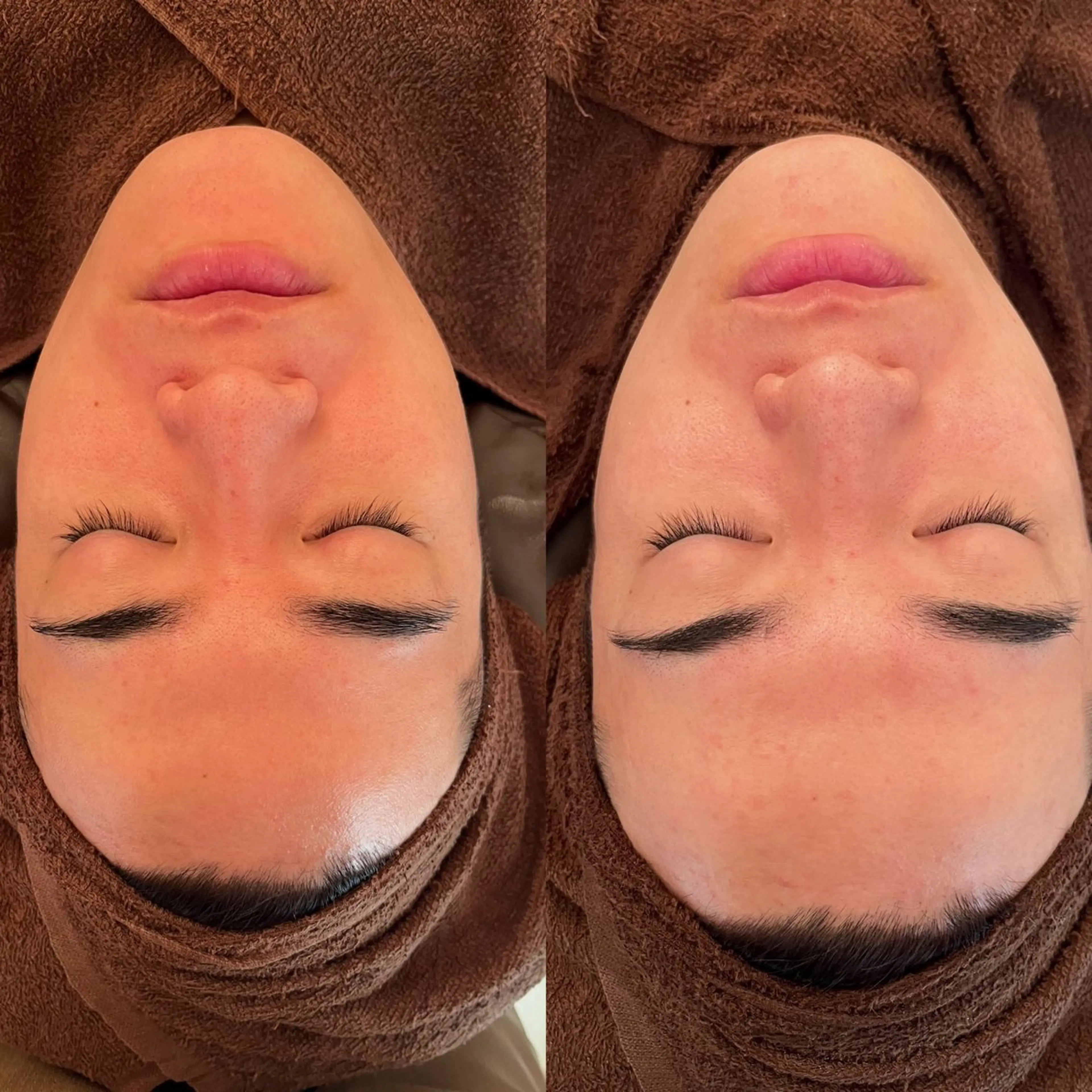 ツヤ肌No.1 パーフェクトハイドラスパークコース/ 全ての毛穴トラブルにはこれ！美容液導入.マッサージ付きの写真