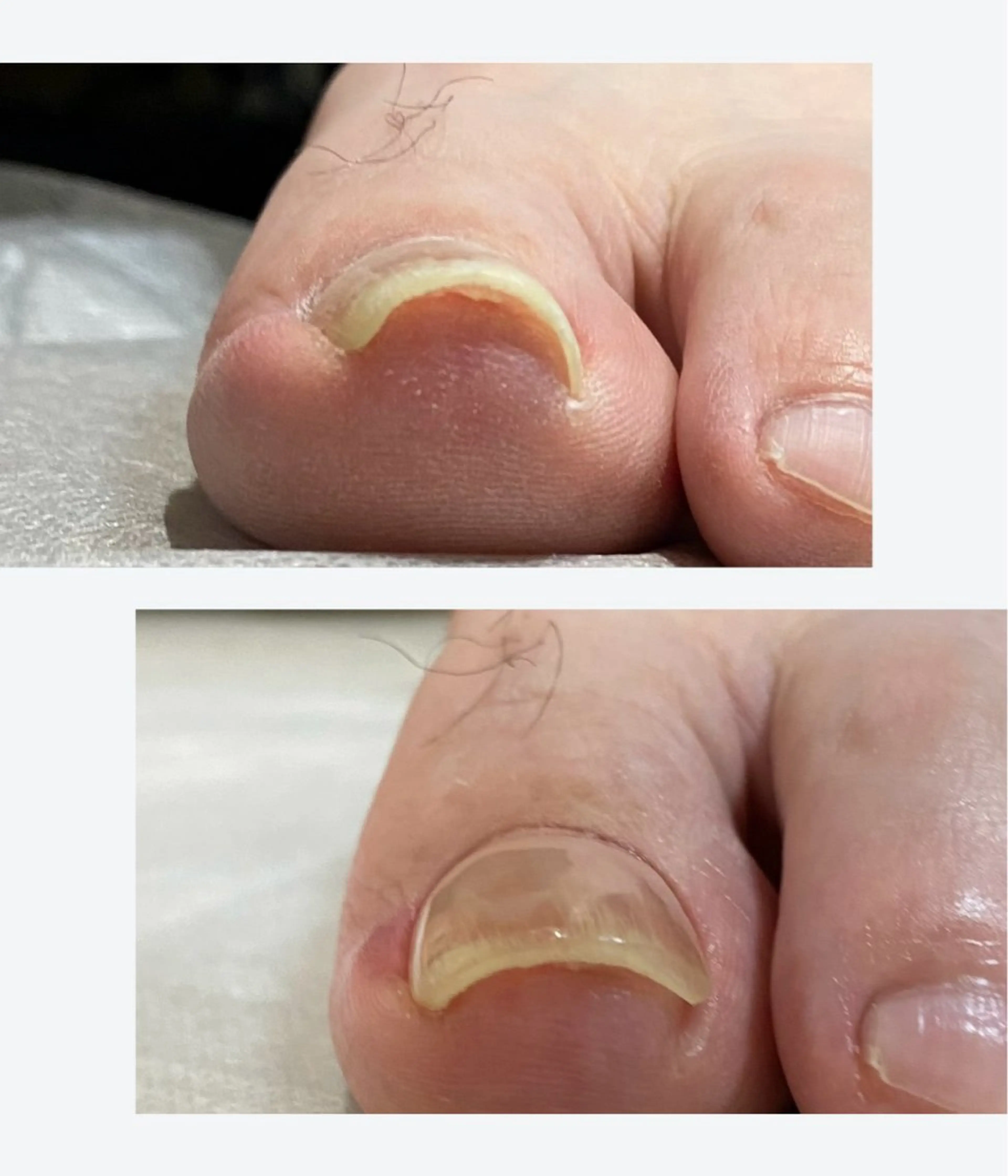 巻き爪ケア　親指1本　軽度　カウンセリング付きの写真