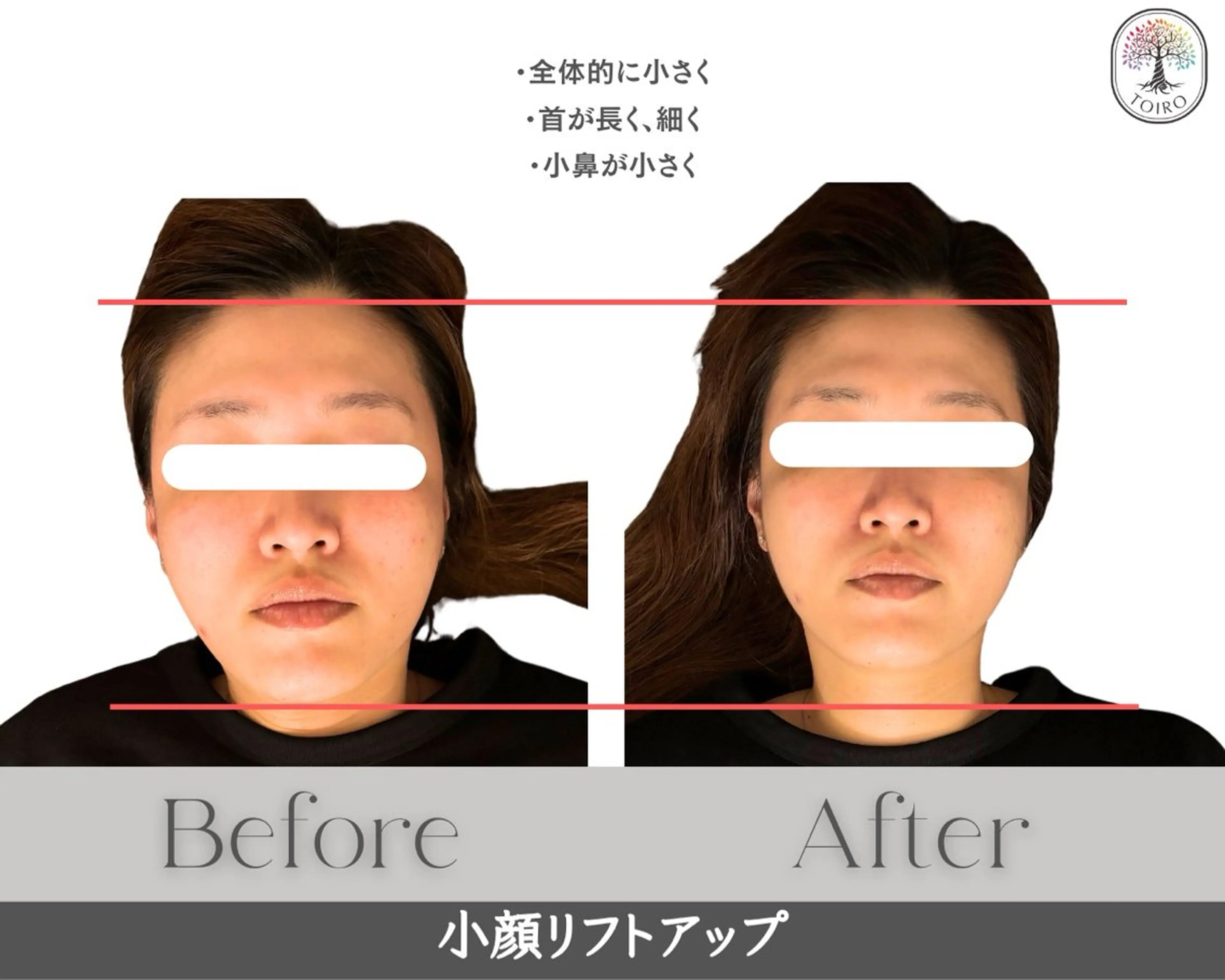 【小顔リフトアップ＋ヘッドスパ】小顔矯正×細胞レベルに働きかける高機能ジェルで徹底ケア✨ヘッドスパでさらに引き上げ⤴️の写真