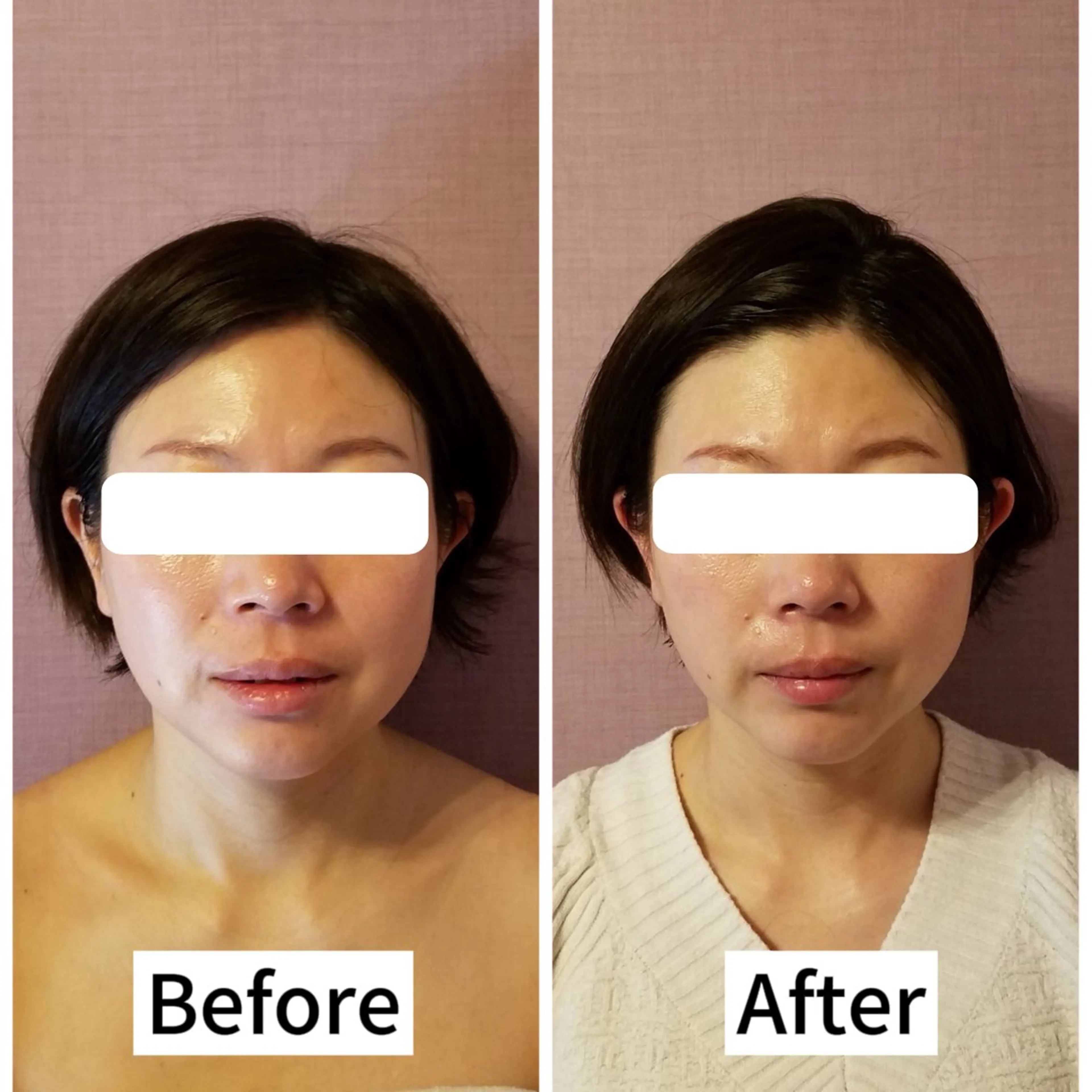 毎月3名様限定【お得な3回回数券🉐モニター価格】テラボーラーで最強小顔!むくみ・たるみ・シミetc. 肌悩みに‼️の写真