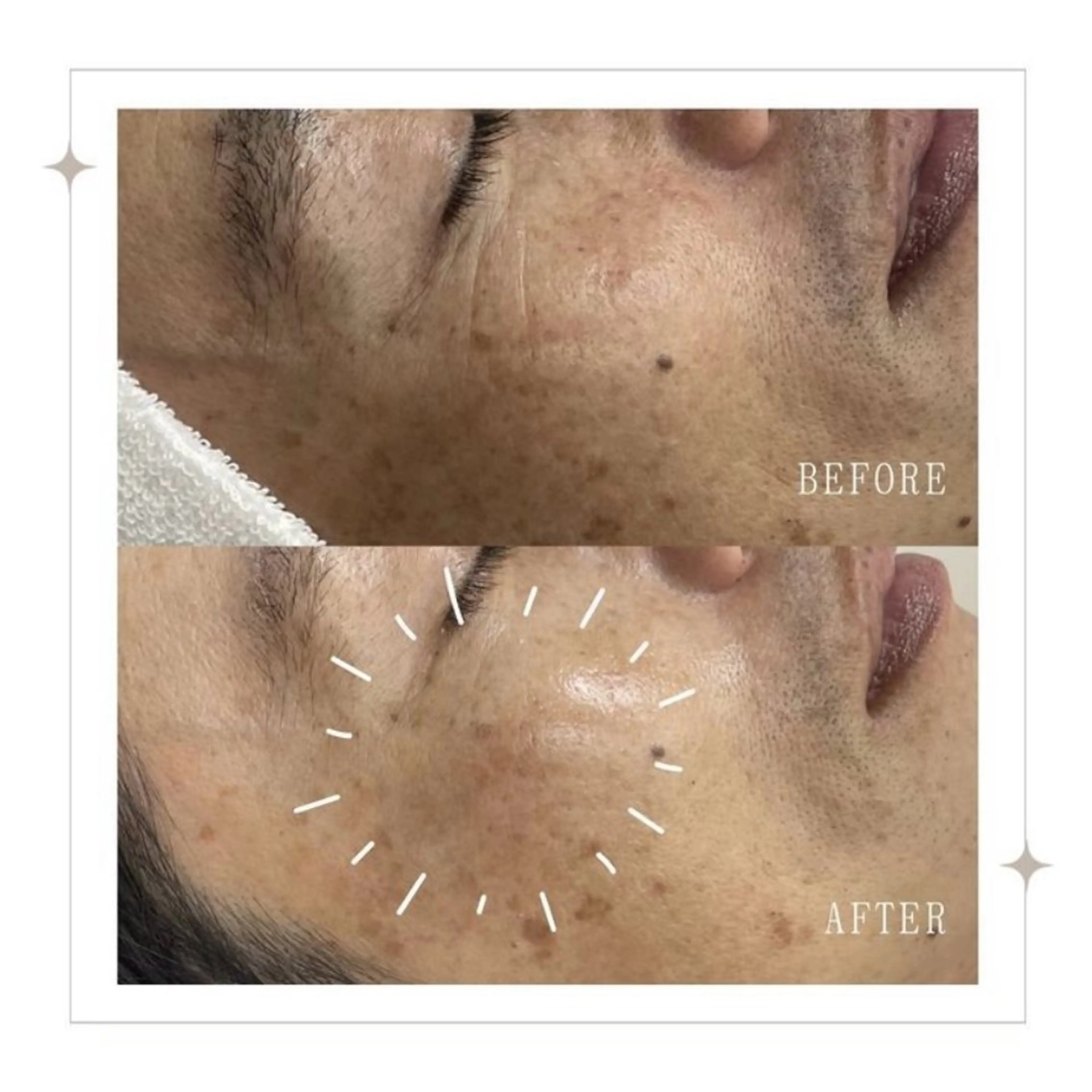 エステ 🌺 SAKI 🌺のマツエク・マツパデザイン