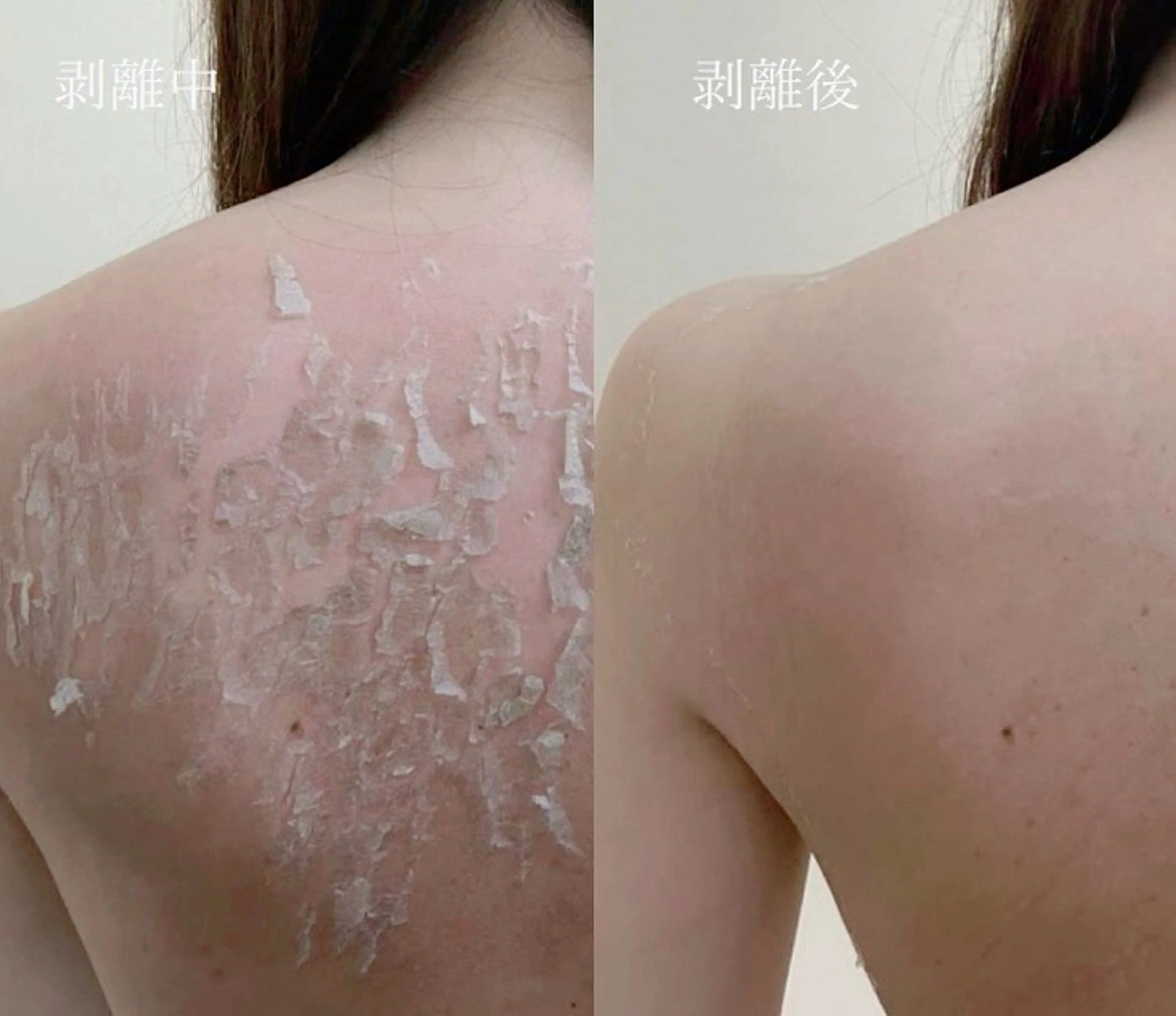 3周年記念期間限定30%OFF【ローズドメーラ】背中です⭐︎剥離&ダウンタイム10〜14日程あります。(個人差あります)の写真