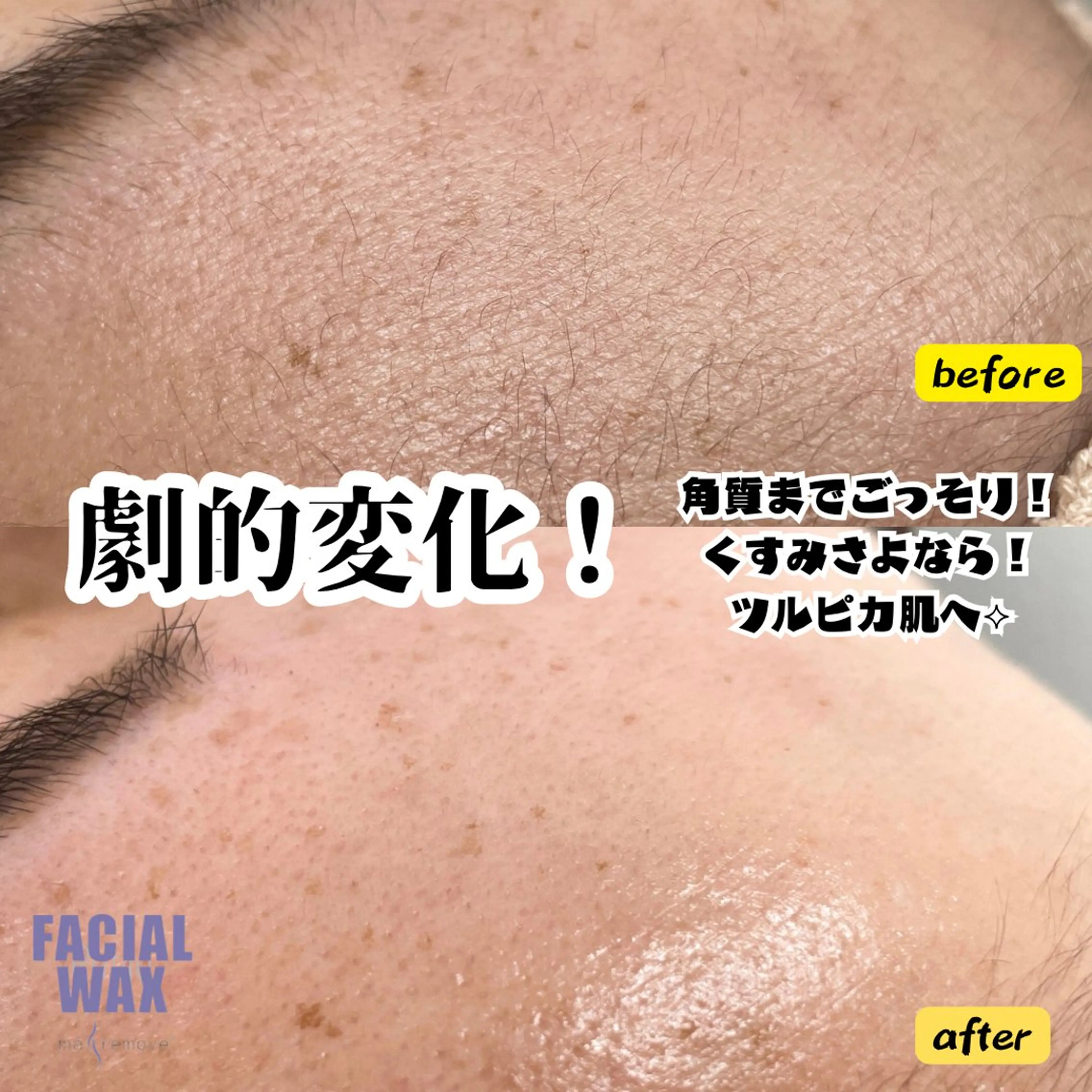 【マリムーブフェイシャルワックス】🌸脱毛🌸の写真