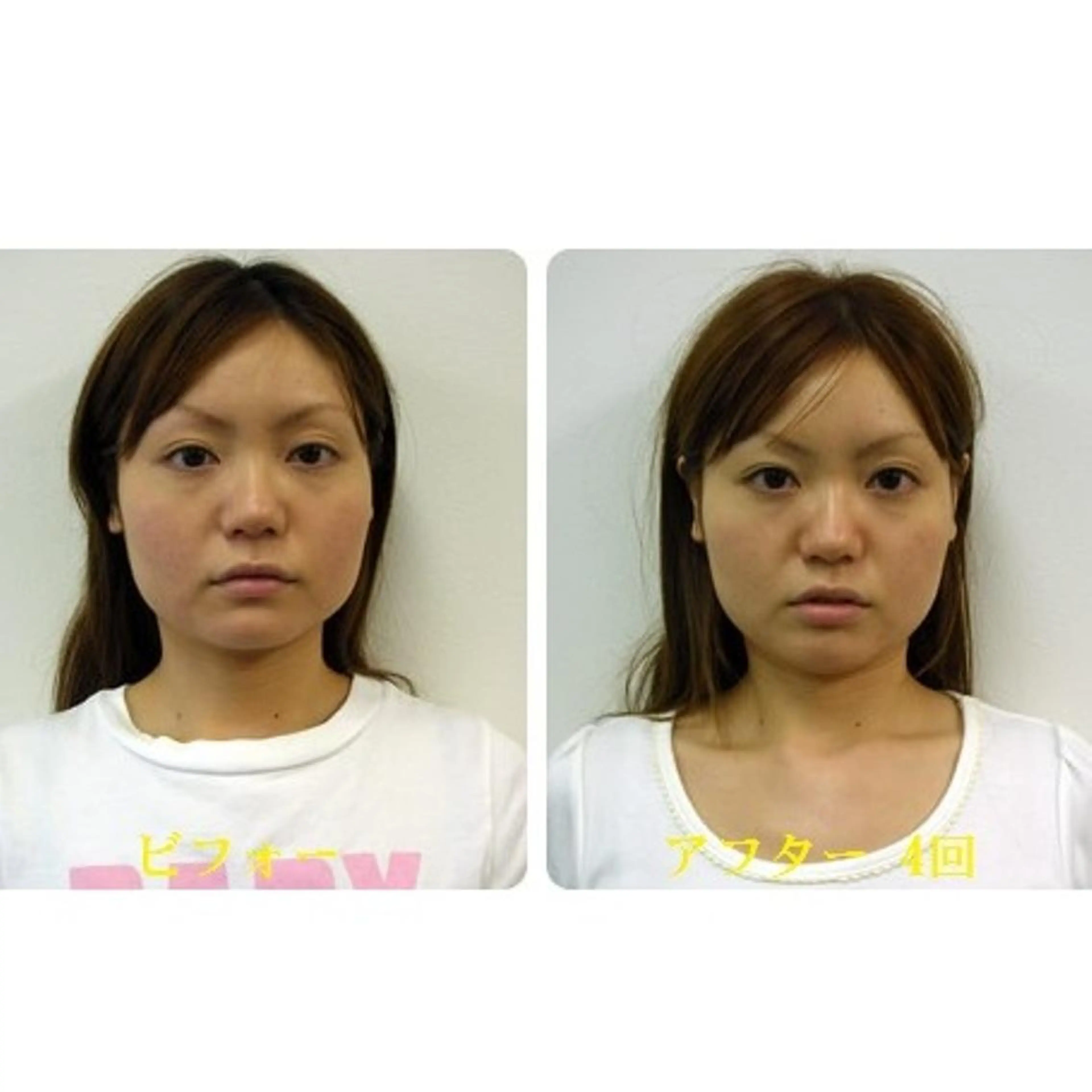 【新規】小顔矯正ベーシックコース/むくみ、たるみ　◆￥11,600 → ￥4,980現金限定の写真