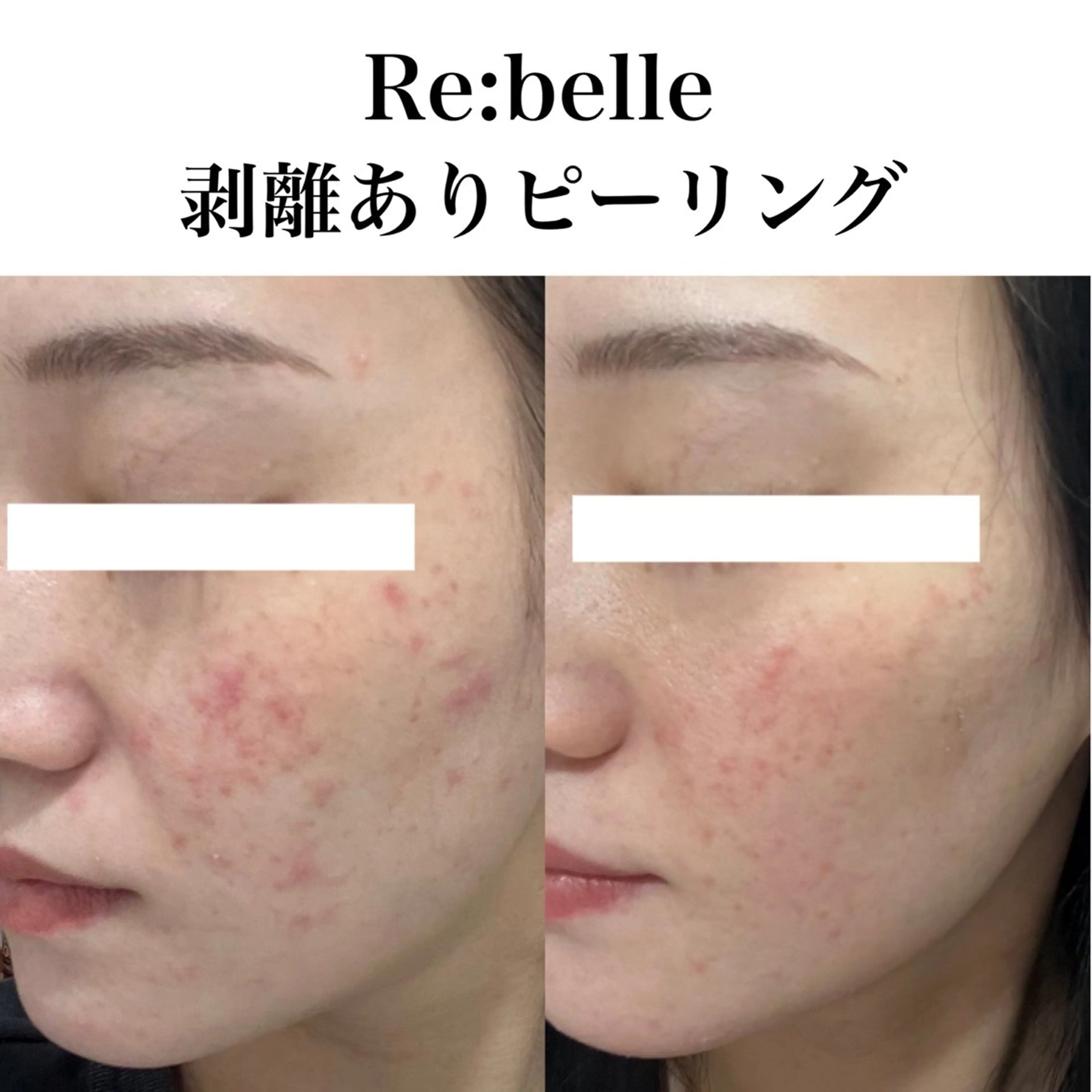 【1回で大変化！医療提携】剥ける！ハーブピーリング🌿幹細胞美容液付き☆の写真