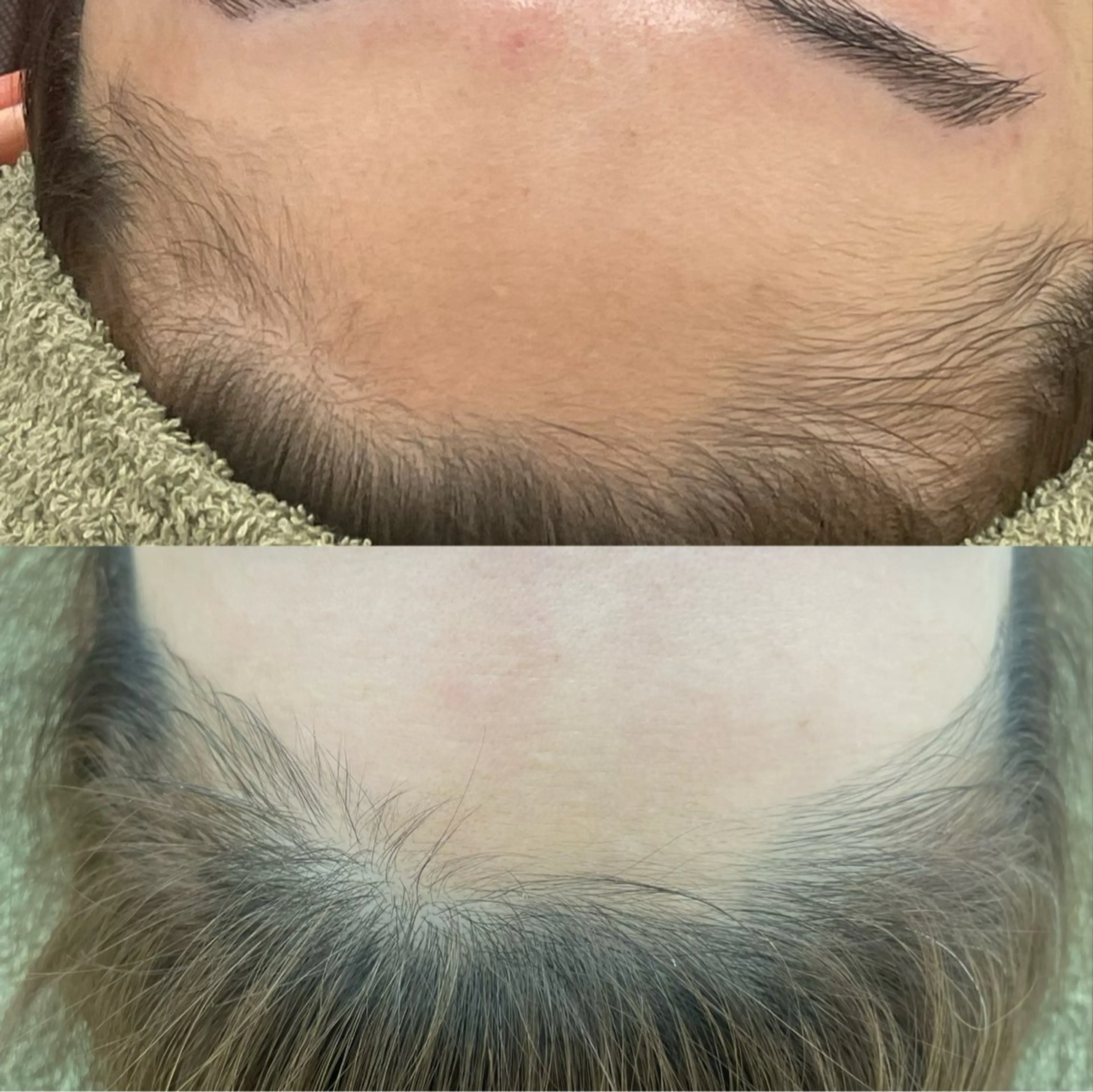 脱毛 suu ｜harukaのマツエク・マツパデザイン