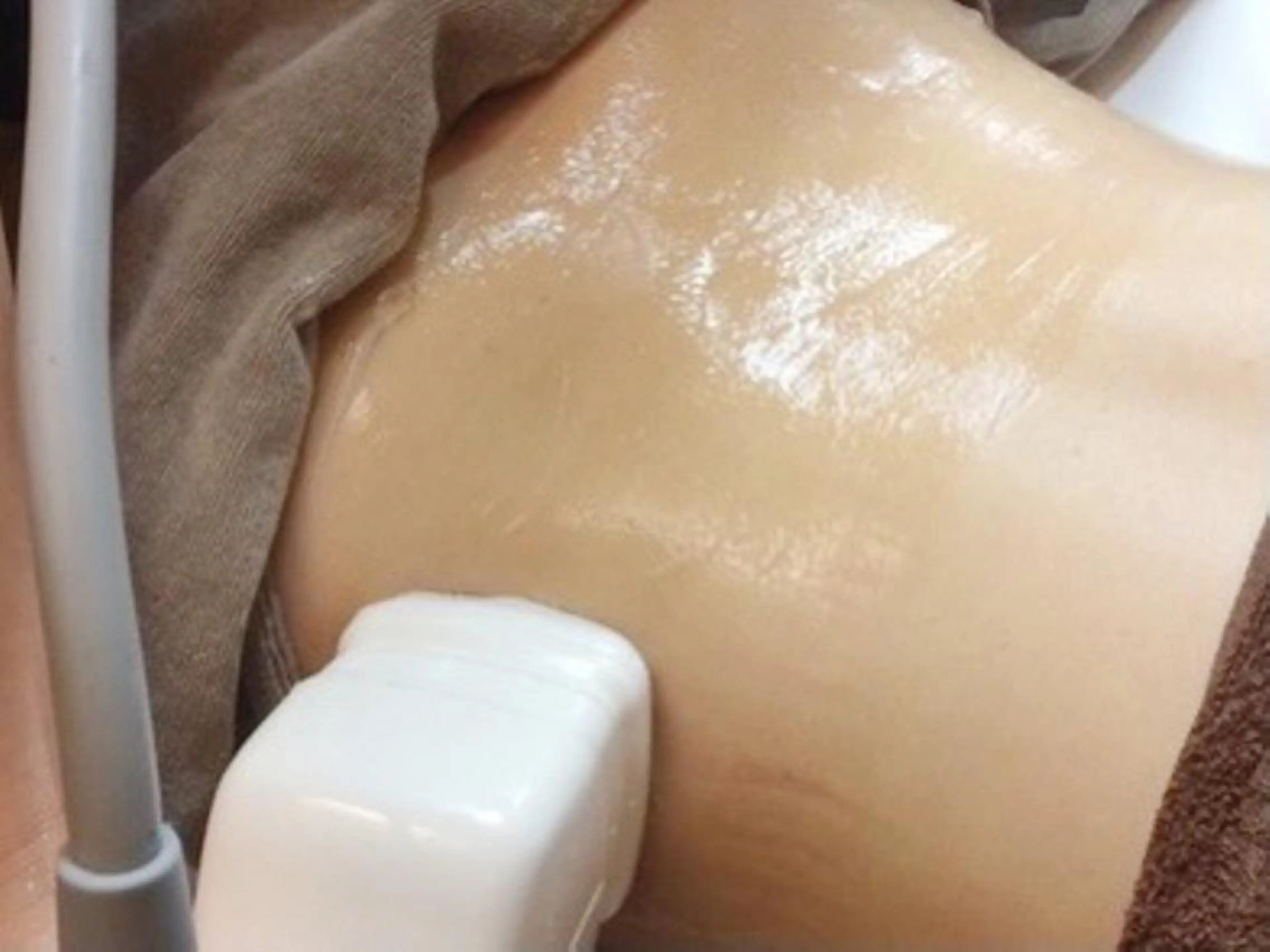 【オーダメイド式高周波焦点スタンプ痩身/キャビバキューム付き☆】4つの機械使用✨1か所徹底痩せコース✨の写真