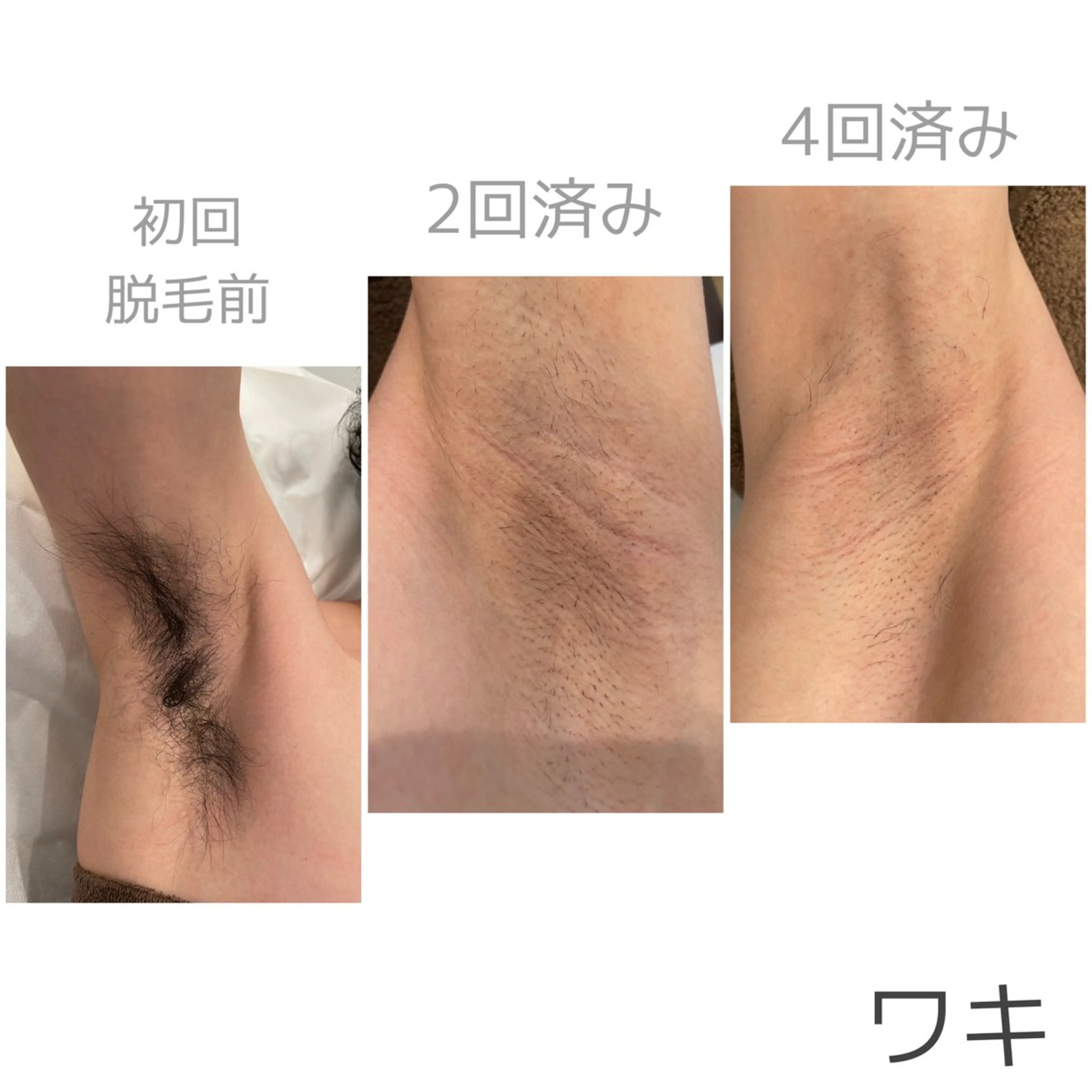 【脱毛】《襟足、ワキ、ヒジ上、ヒジ下》各¥1,500🌟の写真