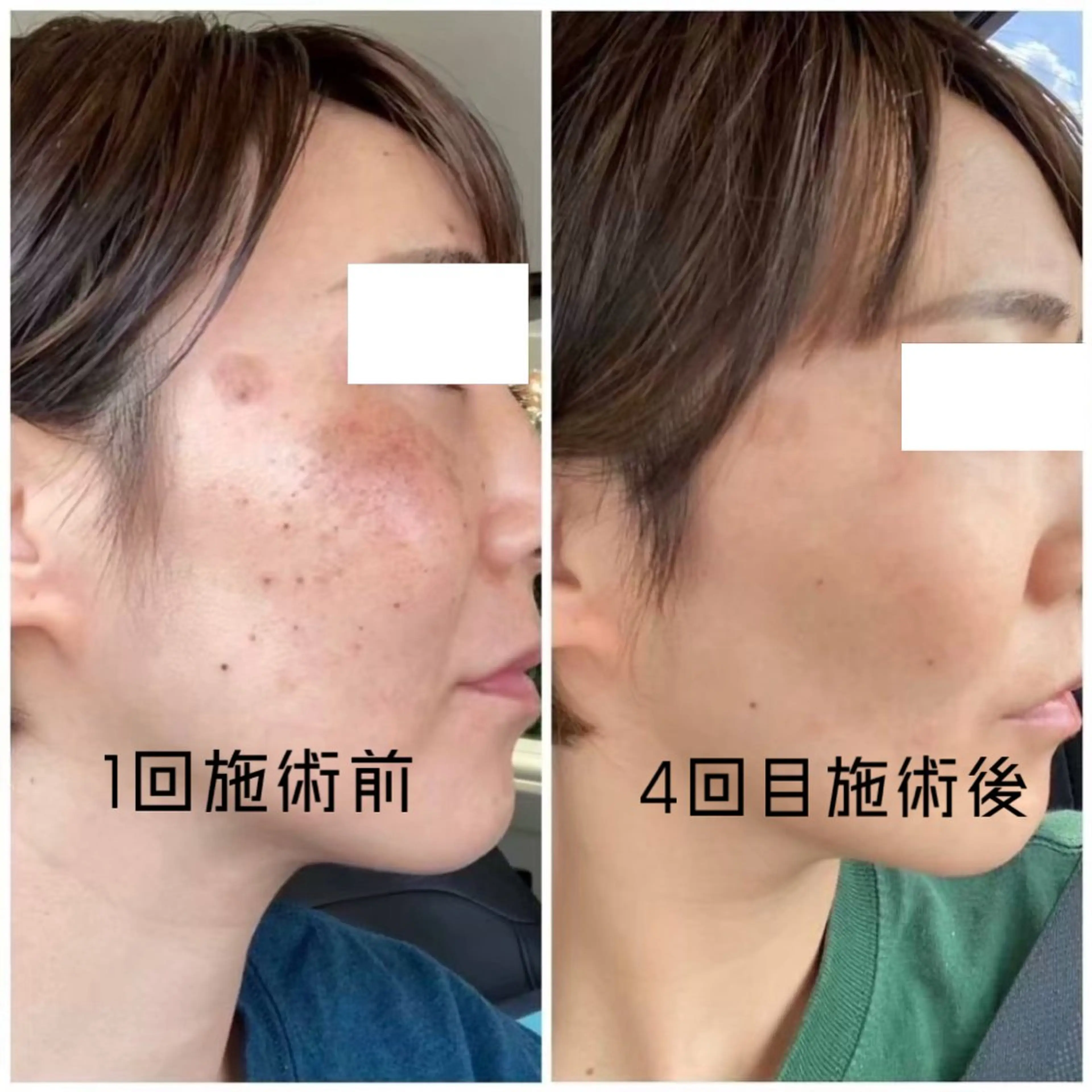 【集中】美肌ケア　【月1回】の写真