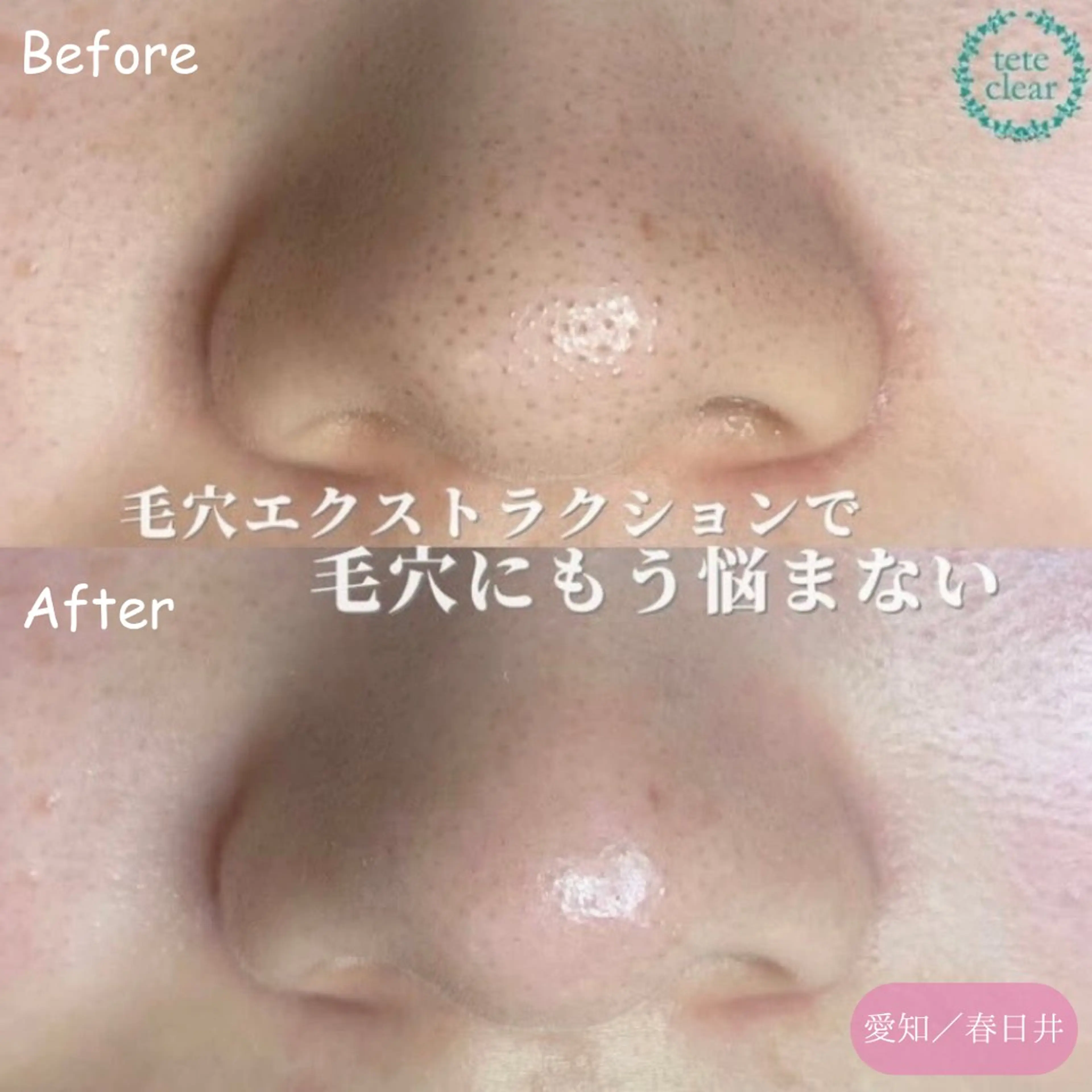 【角栓×黒ずみ×ざらつき撃退】毛穴エクストラクションの写真