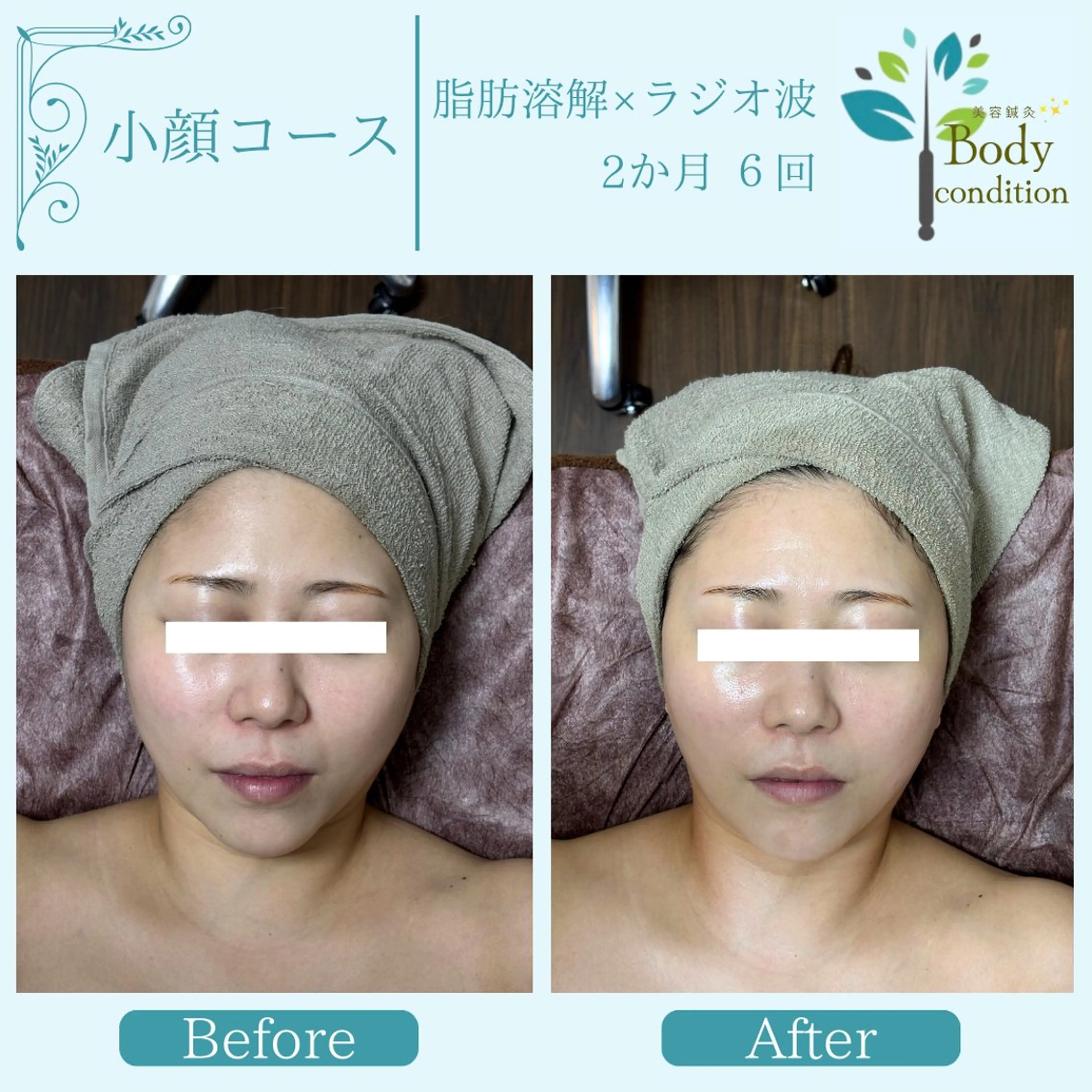 小顔ハーブピーリング 美容鍼/毛穴洗浄のエステ・リラクイメージ