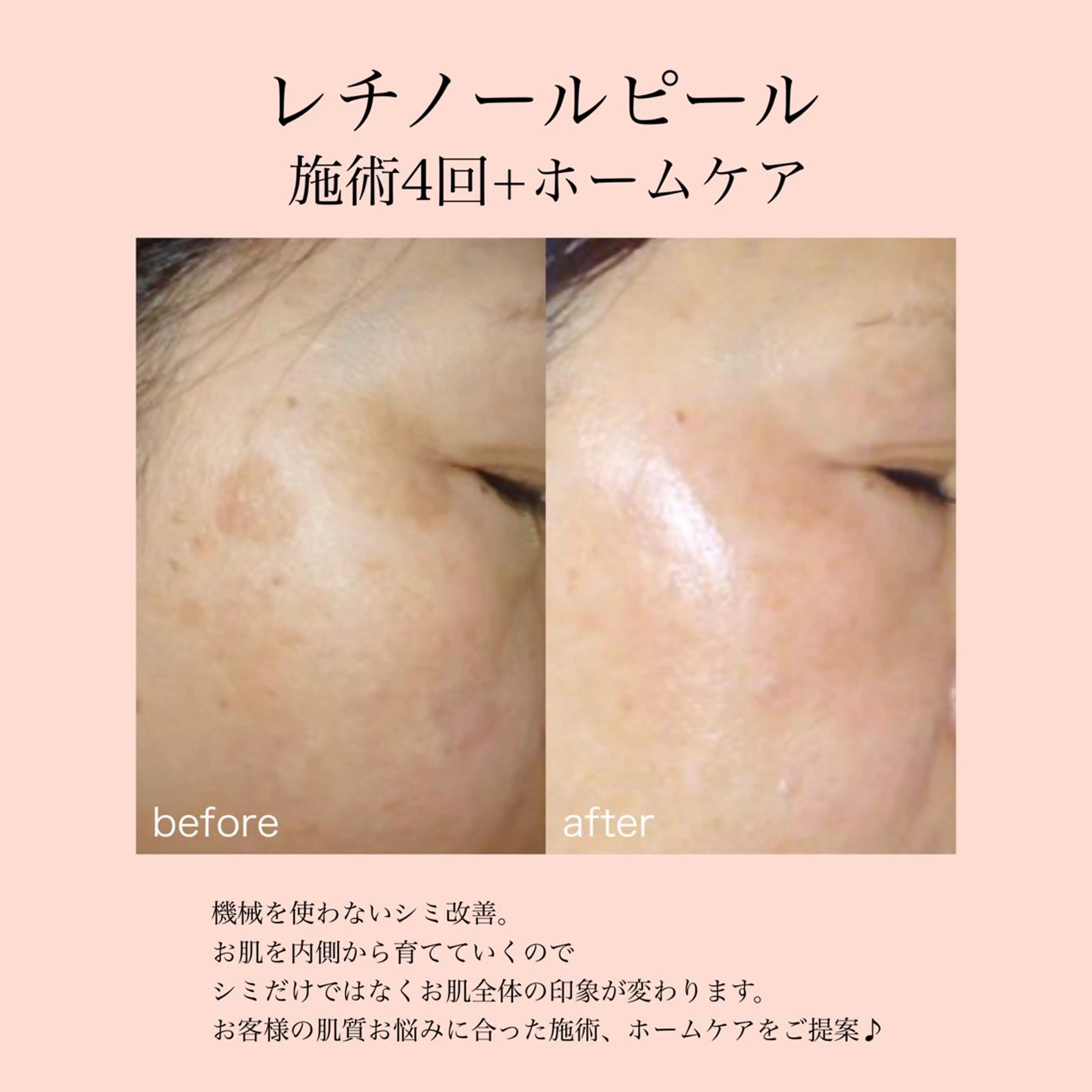 ミニモ限定価格【シミ/シワ/毛穴】何をしても効果を感じれなかったお肌の深いお悩みに◎レチノールピール/敏感肌OKの写真