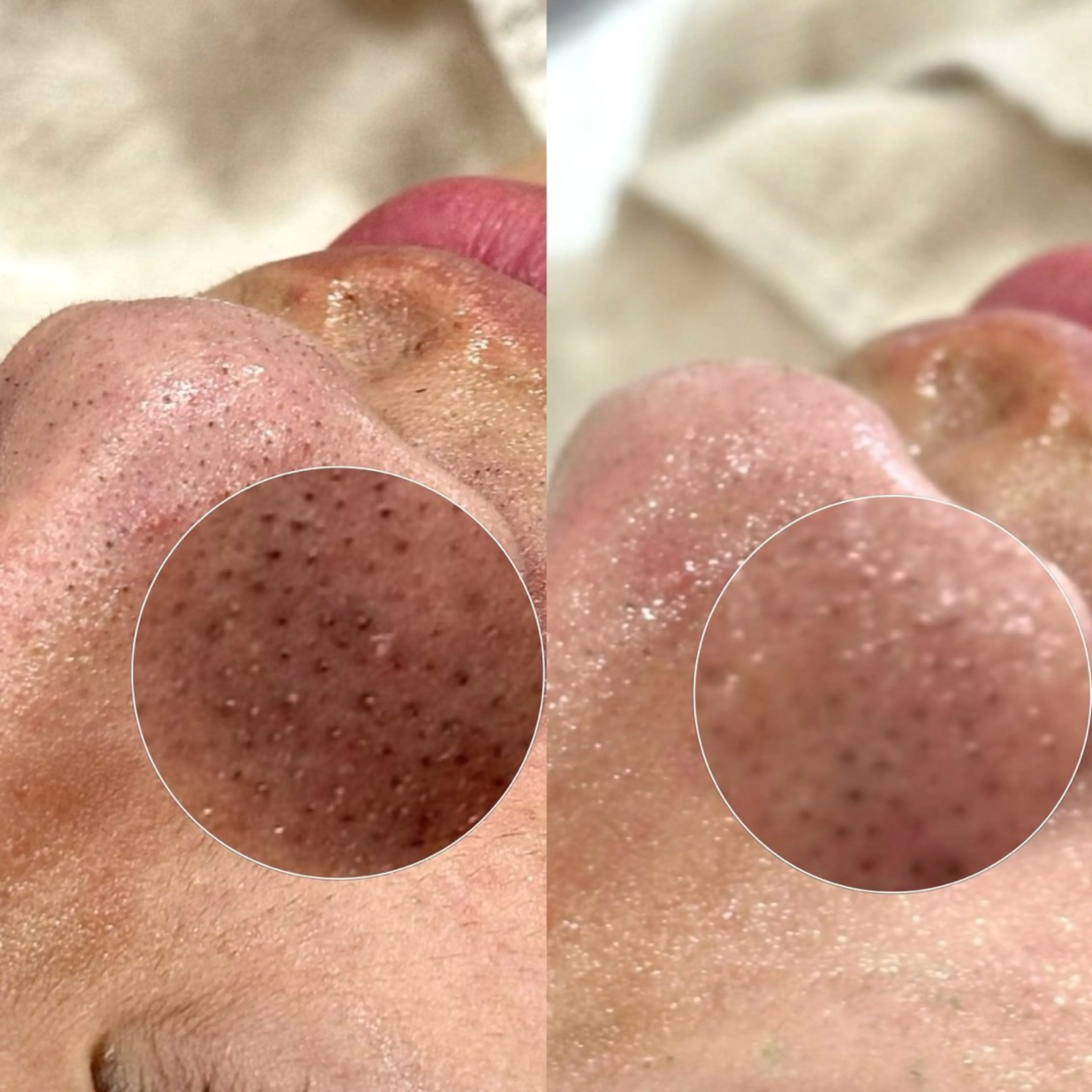 《韓国肌管理🇰🇷》毛穴一掃🫧黒ずみ/角栓/いちご鼻🍓メンズもOK🙆‍♂️毛穴洗浄アクアピール初回¥4,500の写真